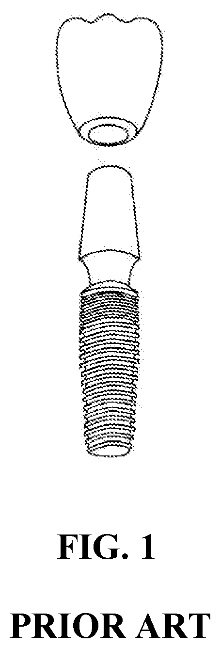 Integral-type implant