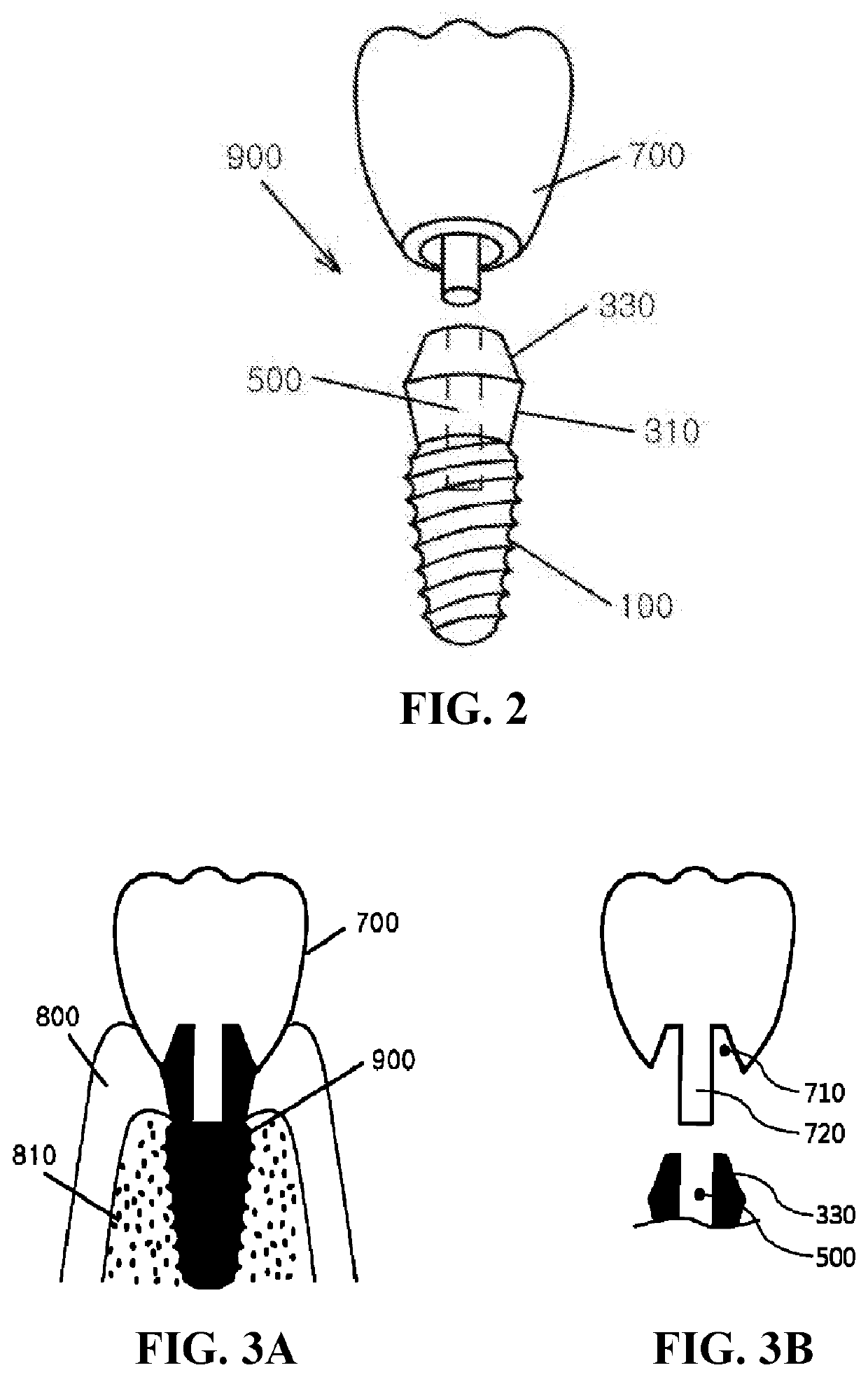 Integral-type implant