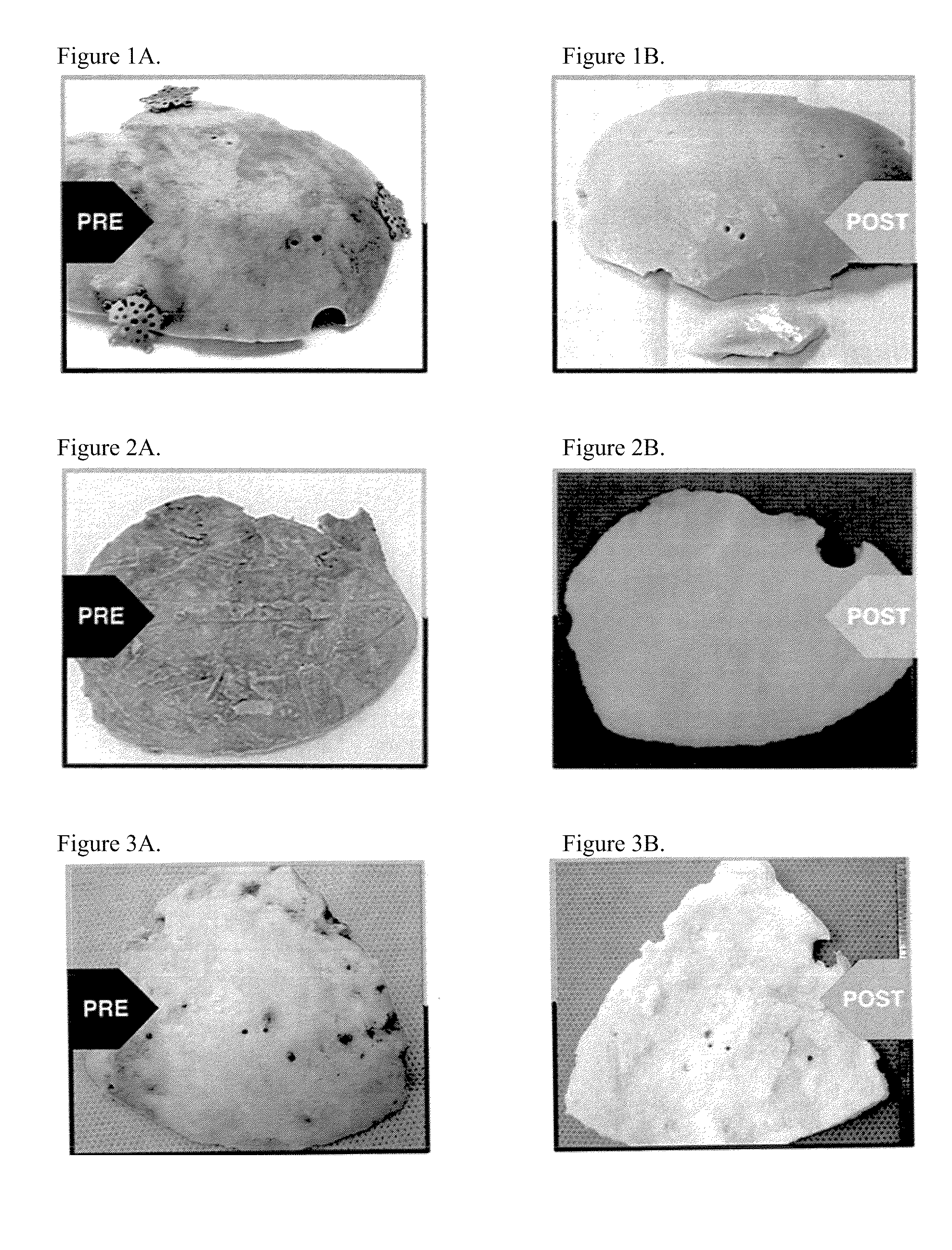 Methods for collecting and processing autografts, processed autografts, kits for collecting and transporting autografts, and tools for preparing autografts