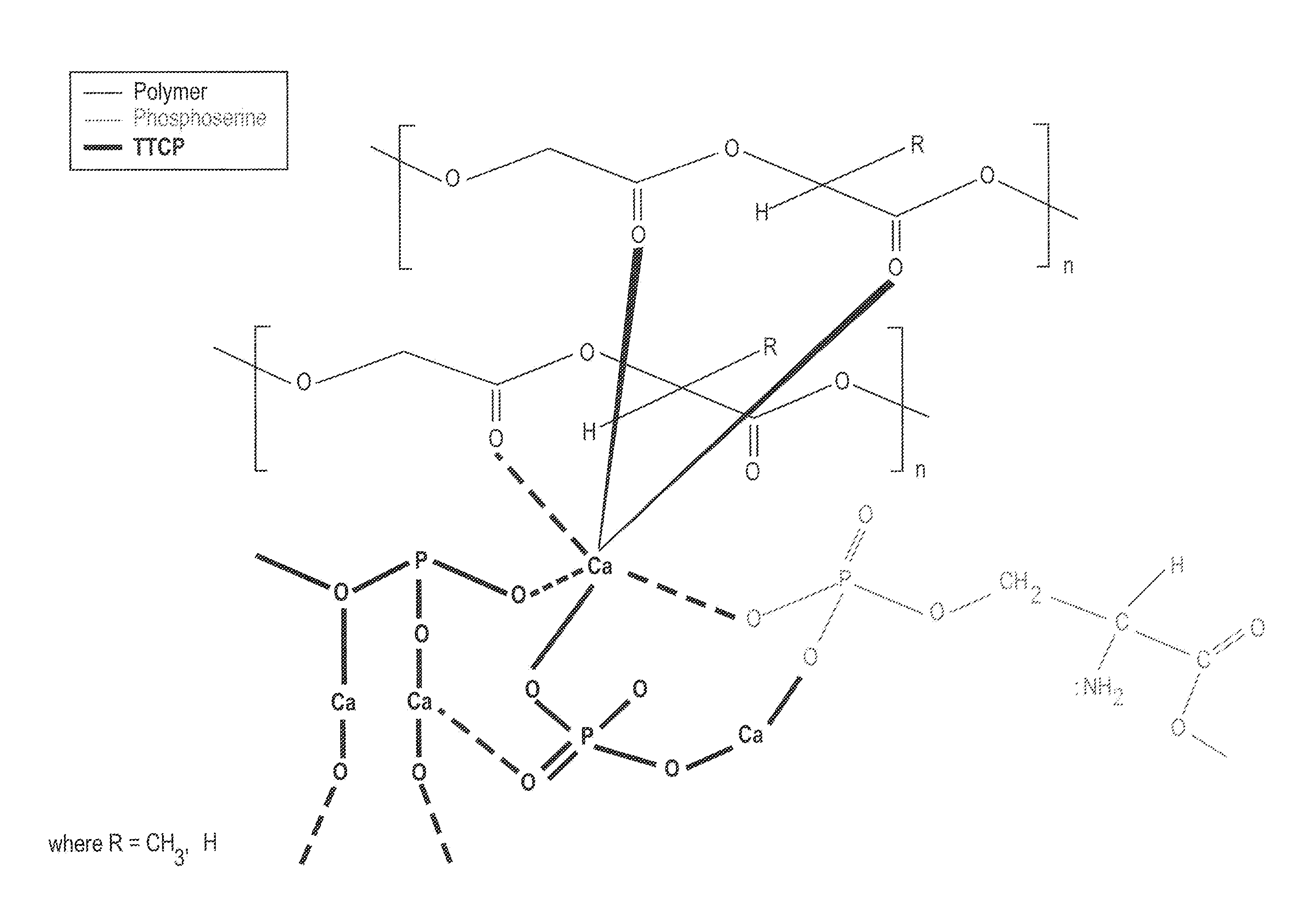 Organophosphorous, multivalent metal compounds, and polymer adhesive interpenetrating network compositions and methods