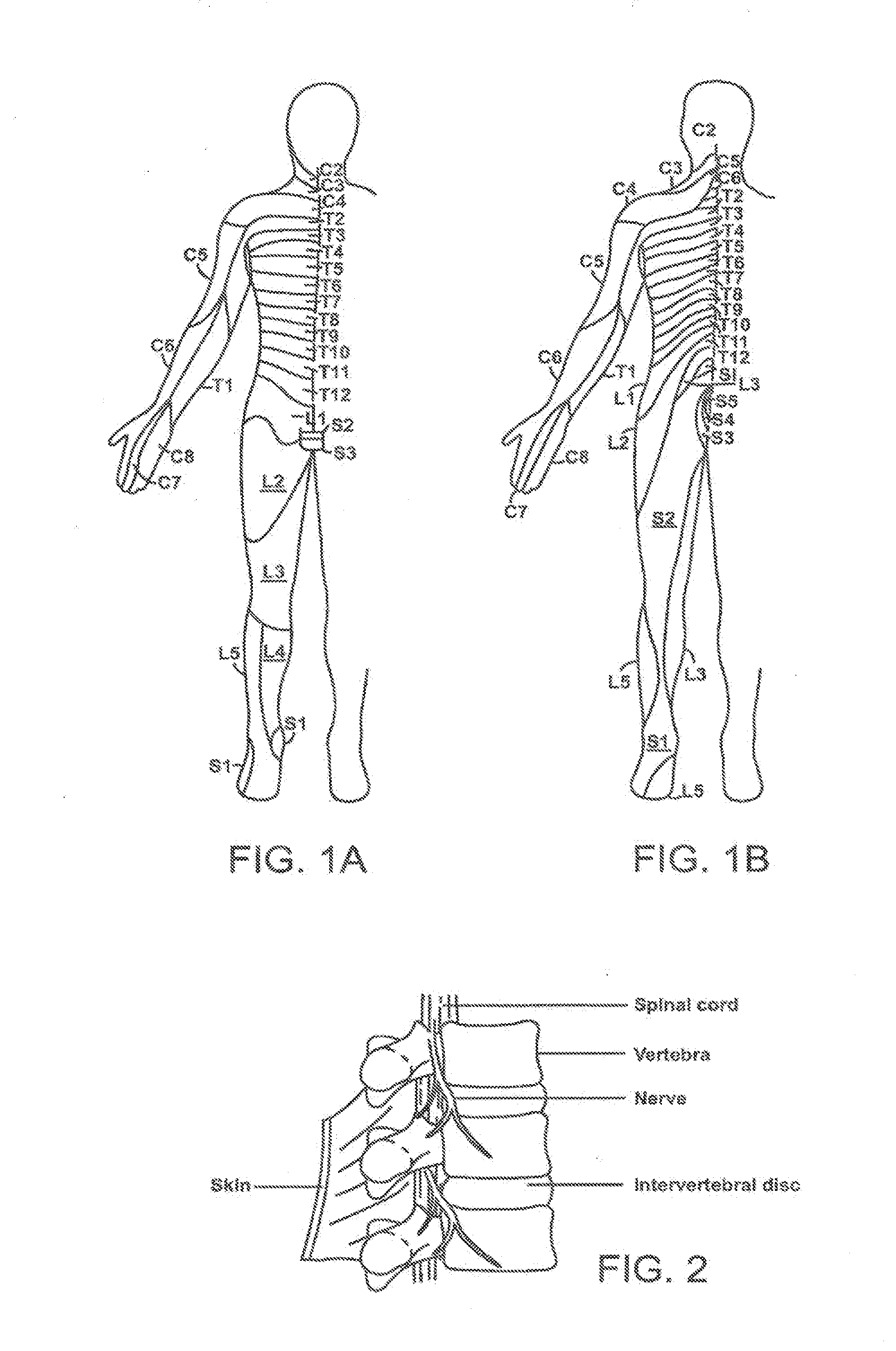 Systems and Methods for Neuromodulation for Treatment of Pain and Other Disorders Associated with Nerve Conduction