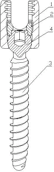 Single-plane pedicle screw