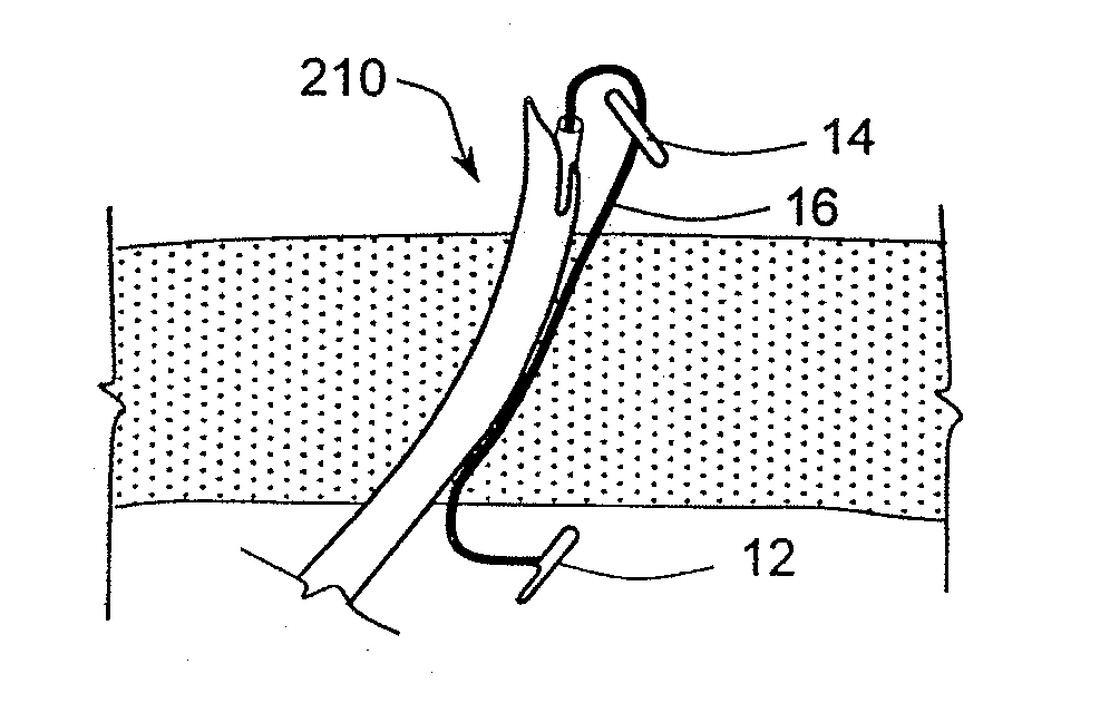 Devices, systems and methods for retracting, lifting, compressing, supporting or repositioning tissues or anatomical structures
