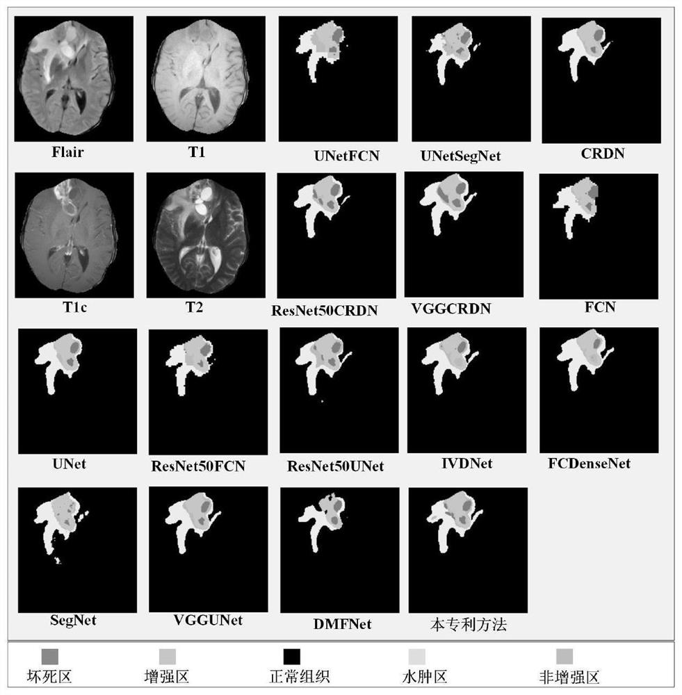 Multi-modal MR image brain tumor segmentation method based on deep learning and multi-guidance