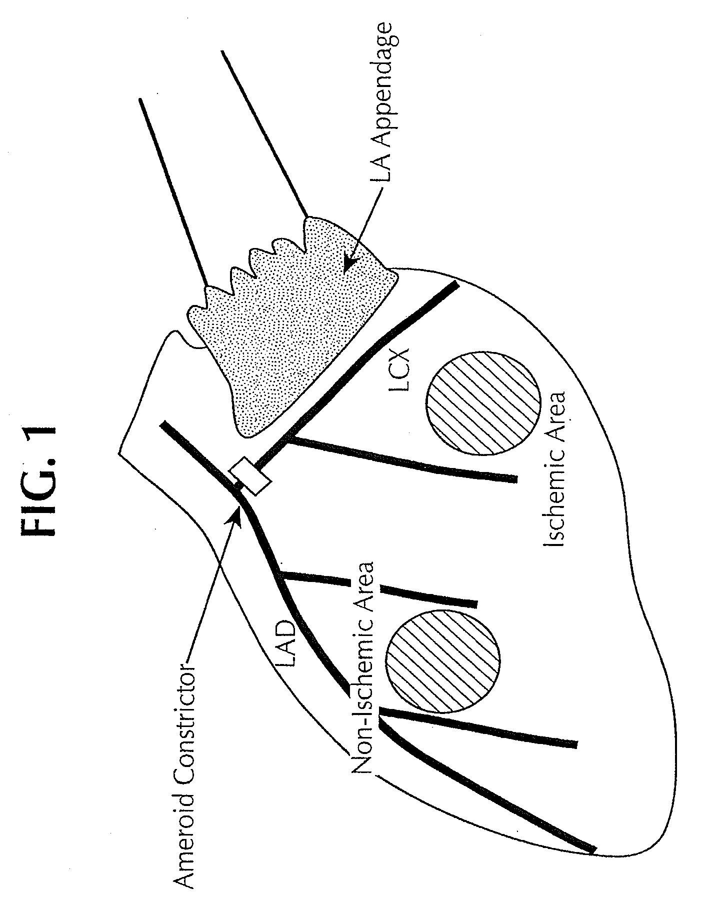 Localized myocardial injection method for treating ischemic myocardium