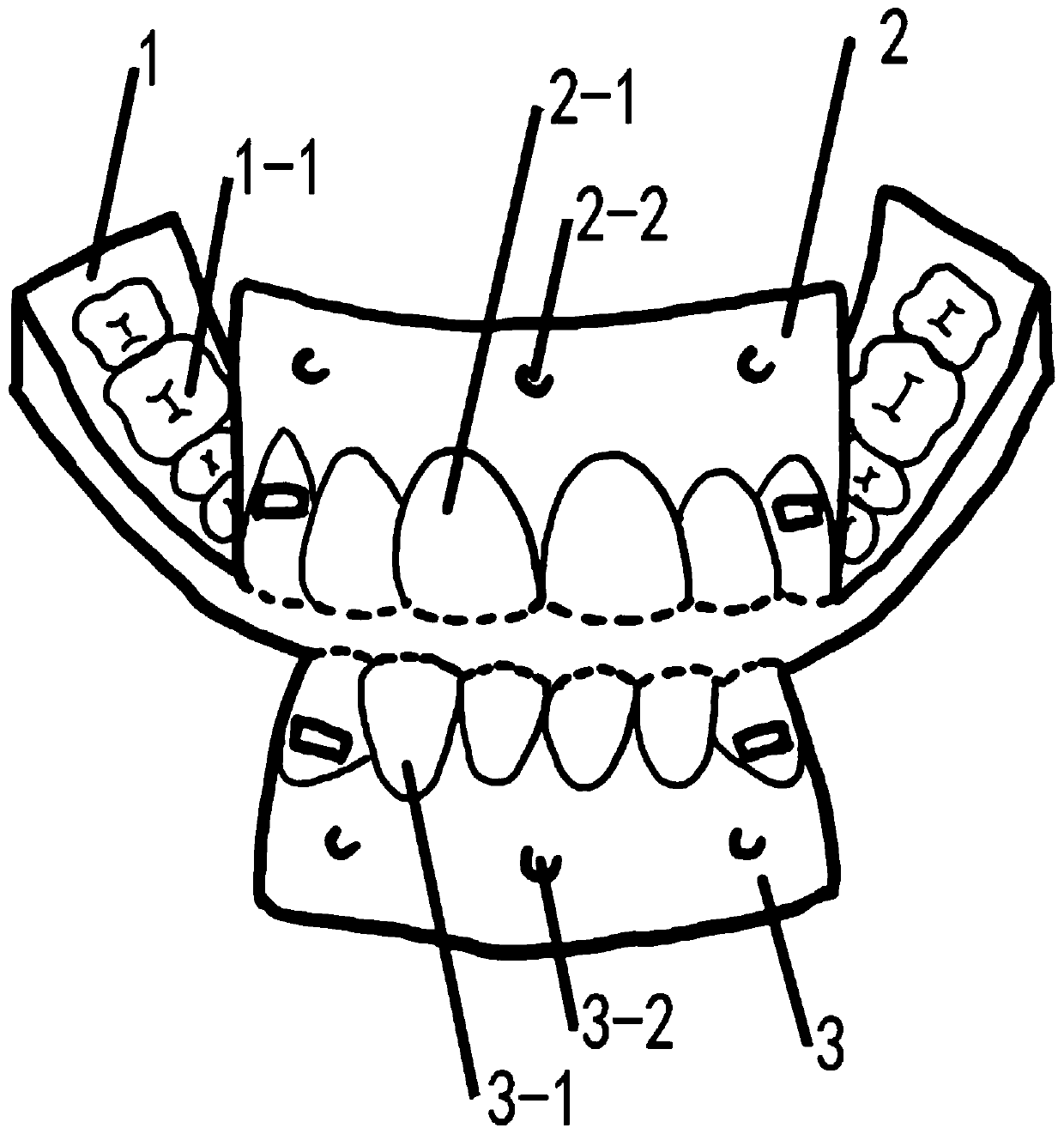 Orthodontic orthognathic surgery positioning device