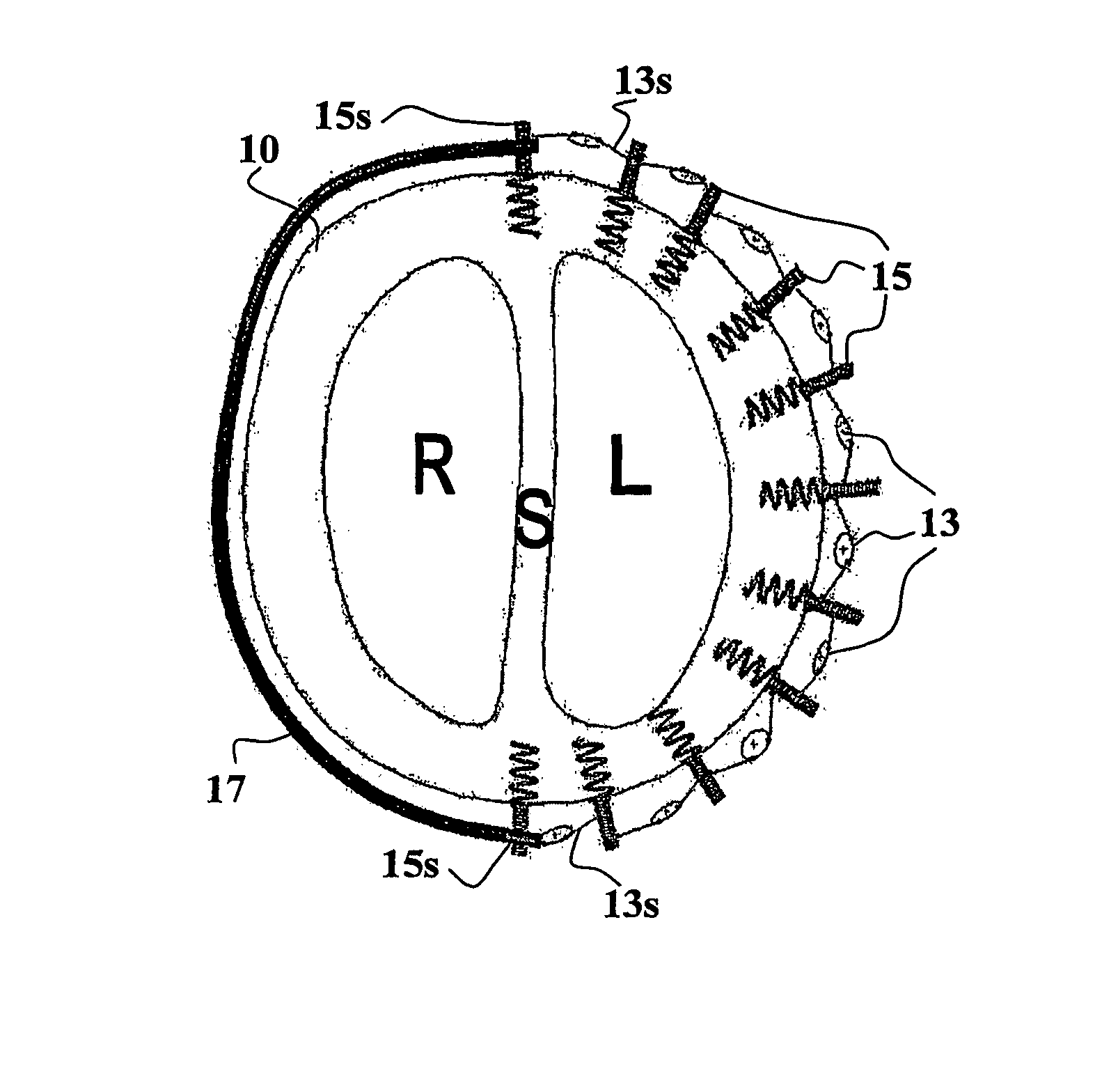 Method and system for improving diastolic function of the heart