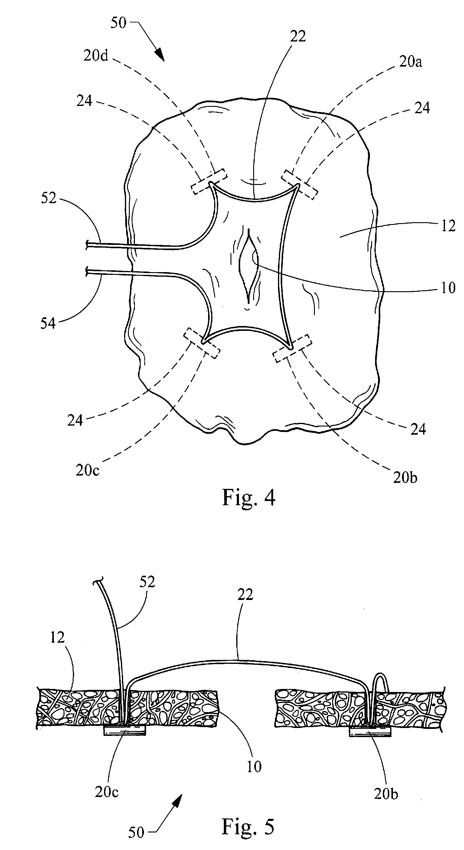 Visceral Anchors For Purse-String Closure of Perforations