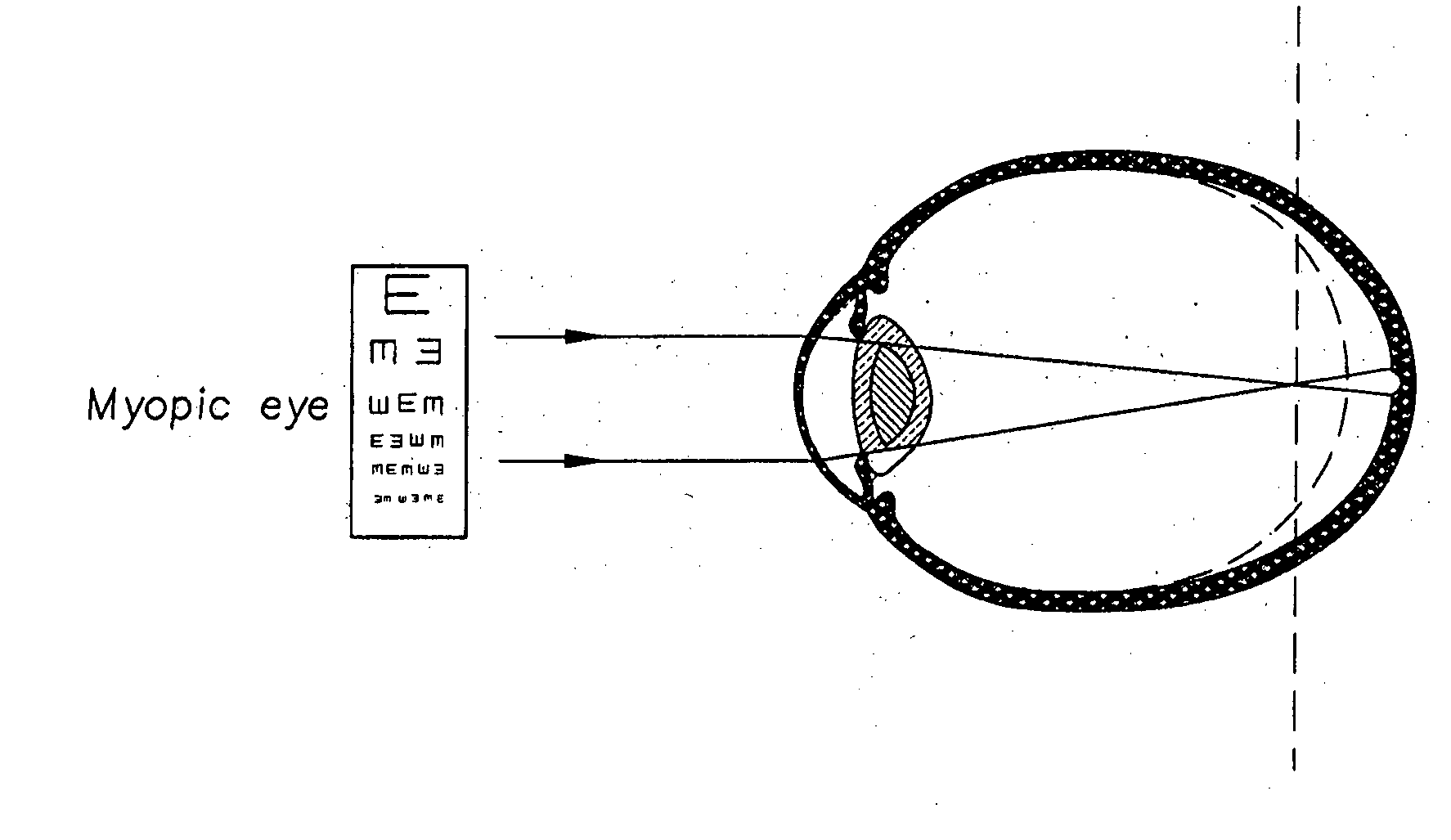 Contact lenses for myopic eyes and methods of treating myopia