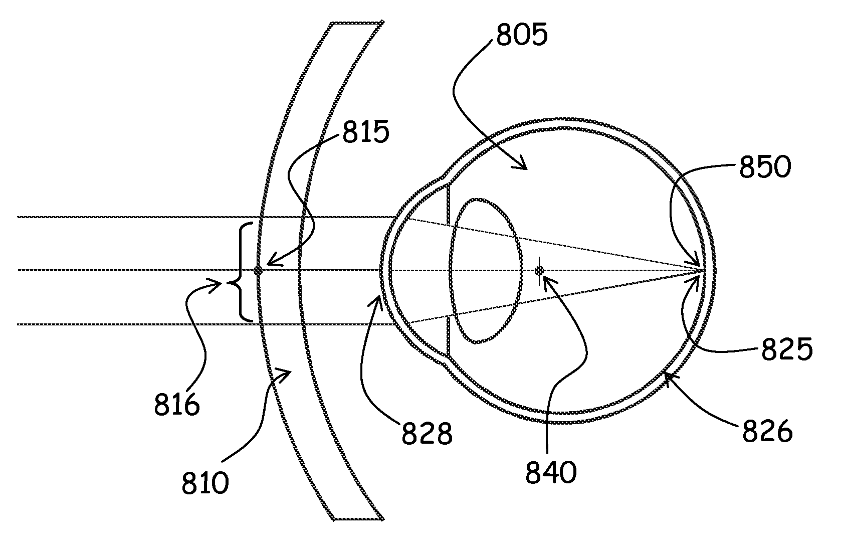 Method and Apparatus for Controlling Peripheral Image Position for Reducing Progression of Myopia