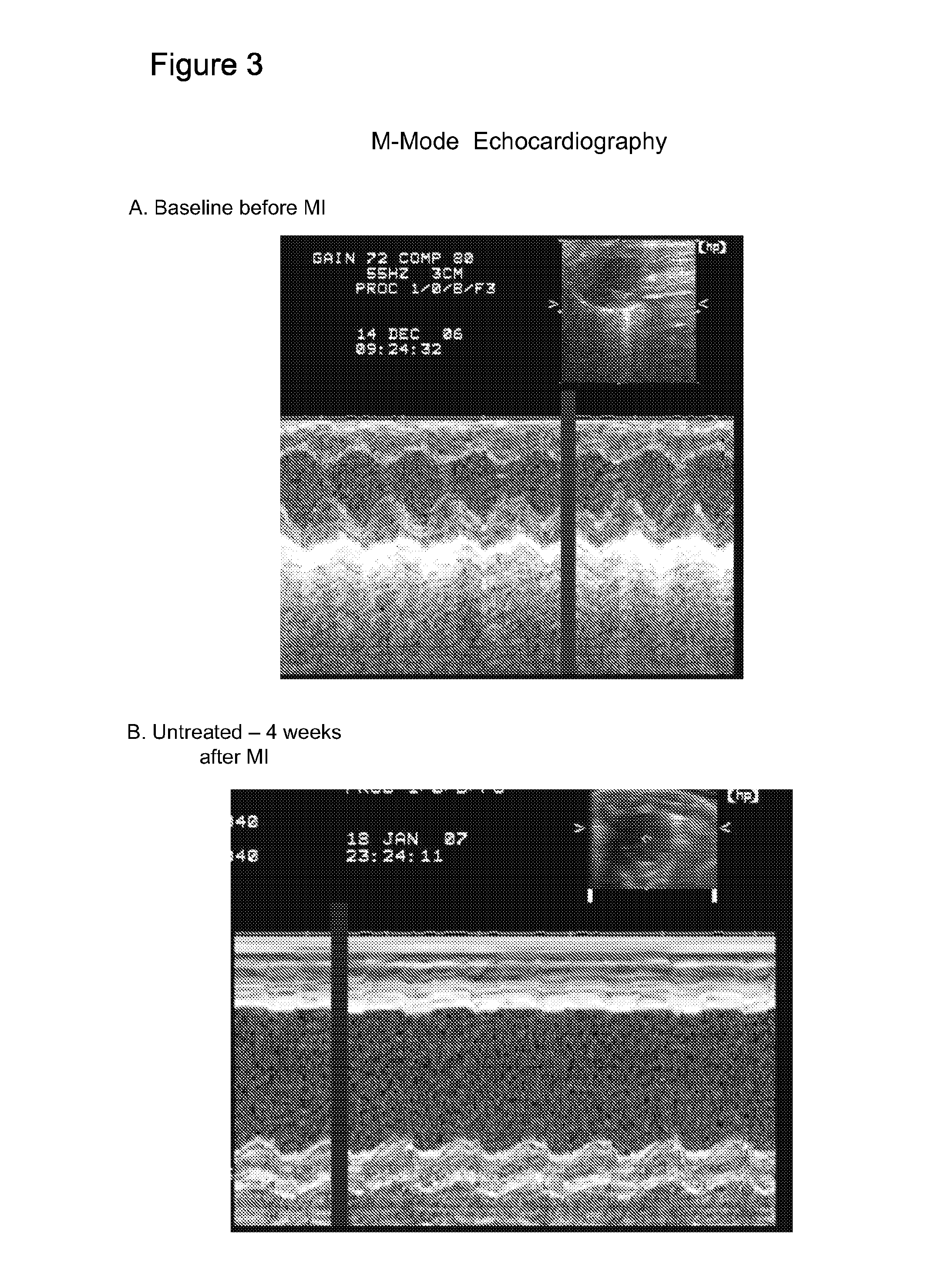 Methods and compositions for inhibiting progression to chronic cardiac failure