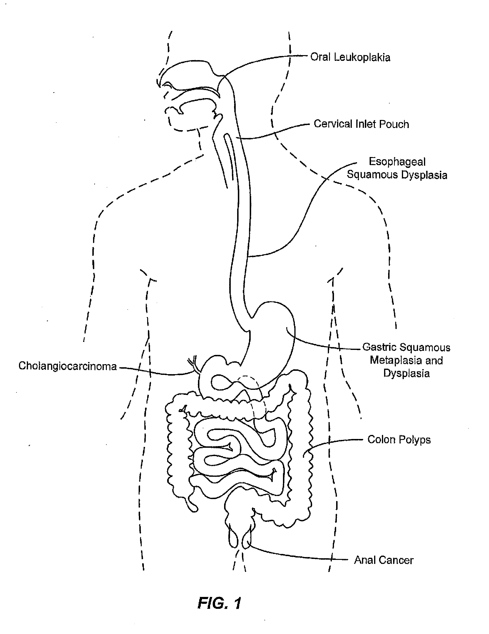 Method and Apparatus for Ablation of Benign, Pre-Cancerous and Early Cancerous Lesions That Originate Within the Epithelium and are Limited to the Mucosal Layer of the Gastrointestinal Tract