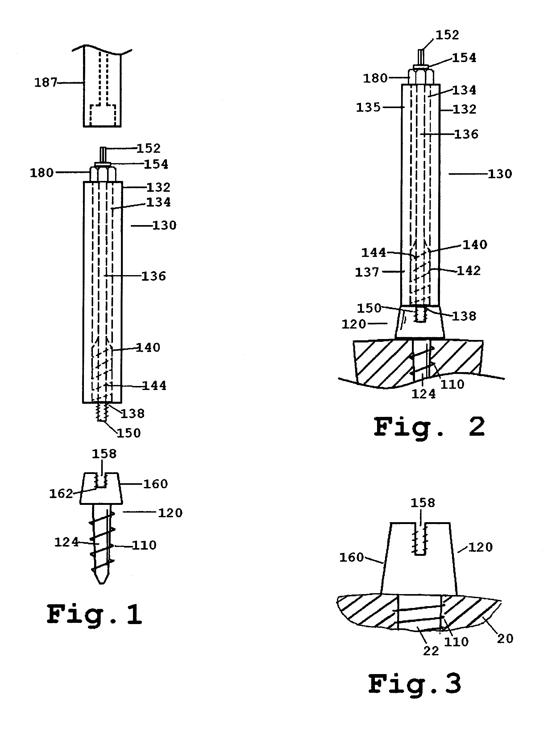 Distraction screw for skeletal surgery and method of use