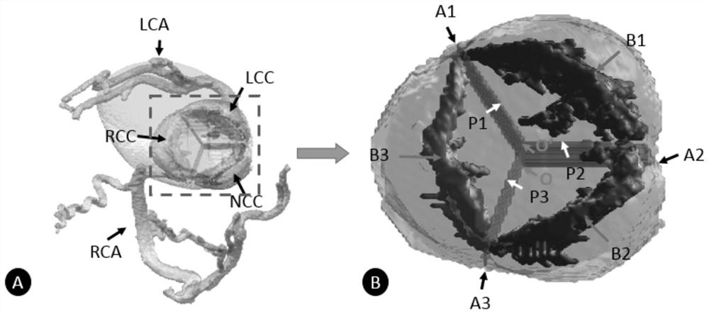 A method for measuring anatomical features of aortic complex