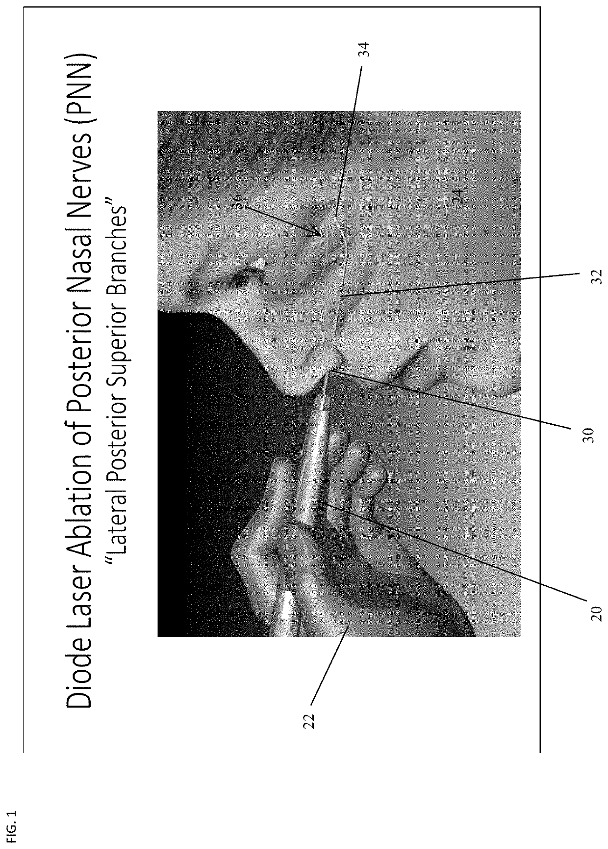 Device and Methods of Laser Treatment for Rhinitis