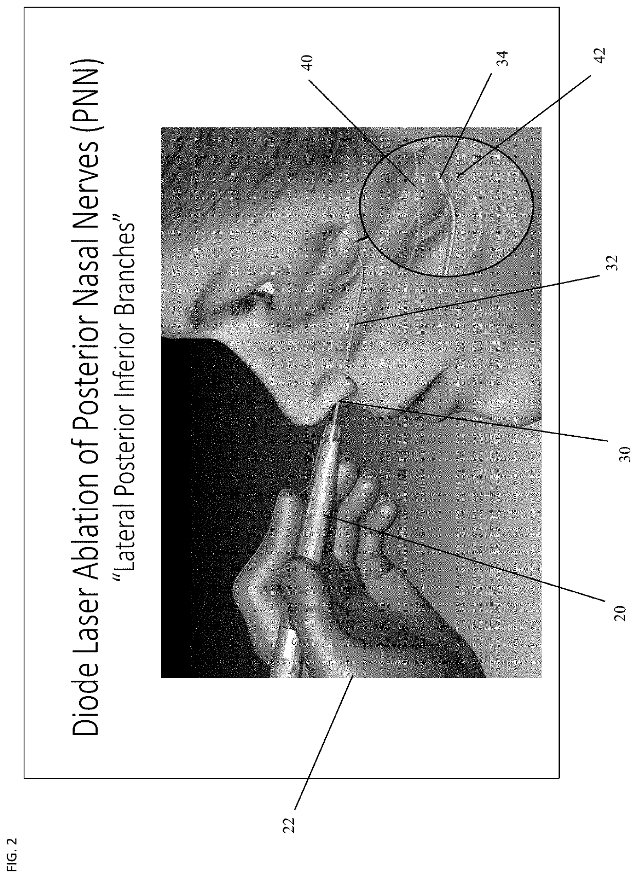 Device and Methods of Laser Treatment for Rhinitis