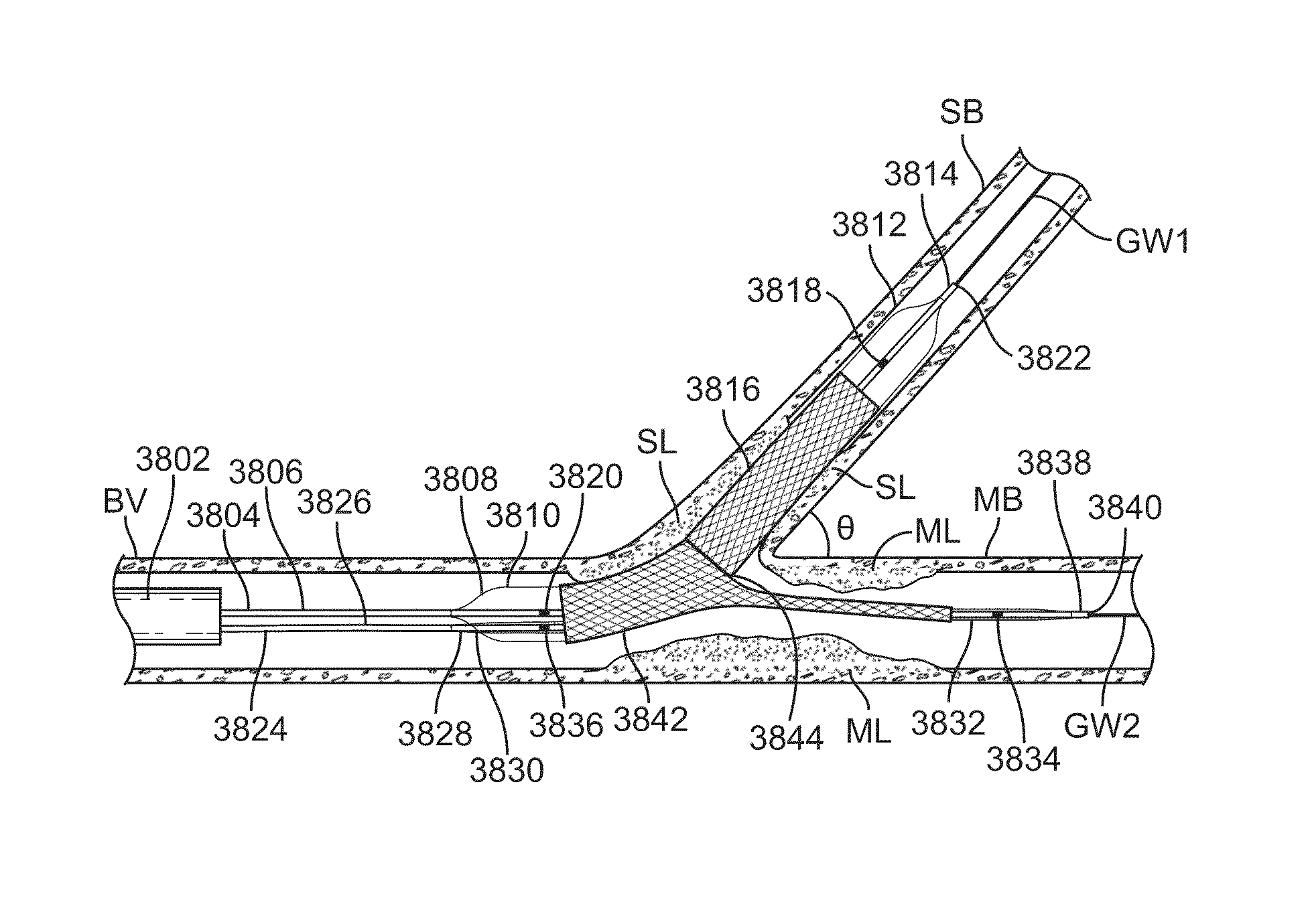 Stent alignment during treatment of a bifurcation