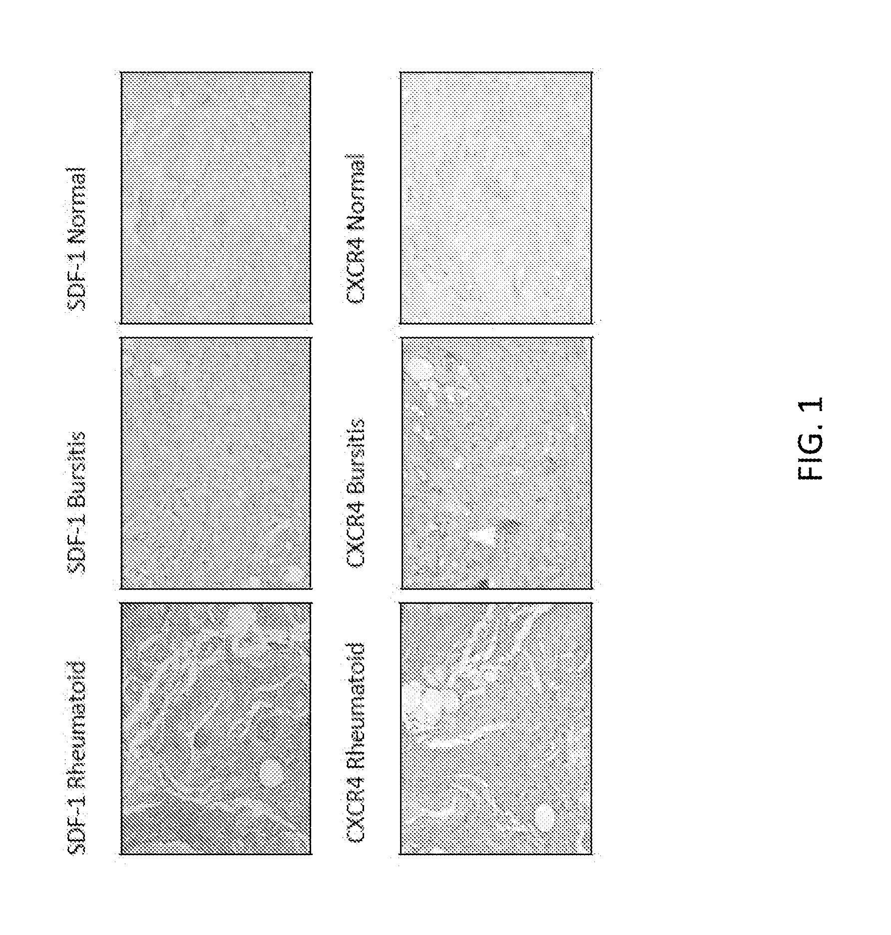 Stromal Derived Factor Inhibition And CXCR4 Blockade