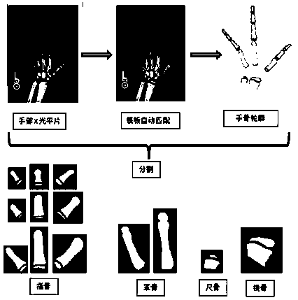 An automatic hand bone segmentation method based on template