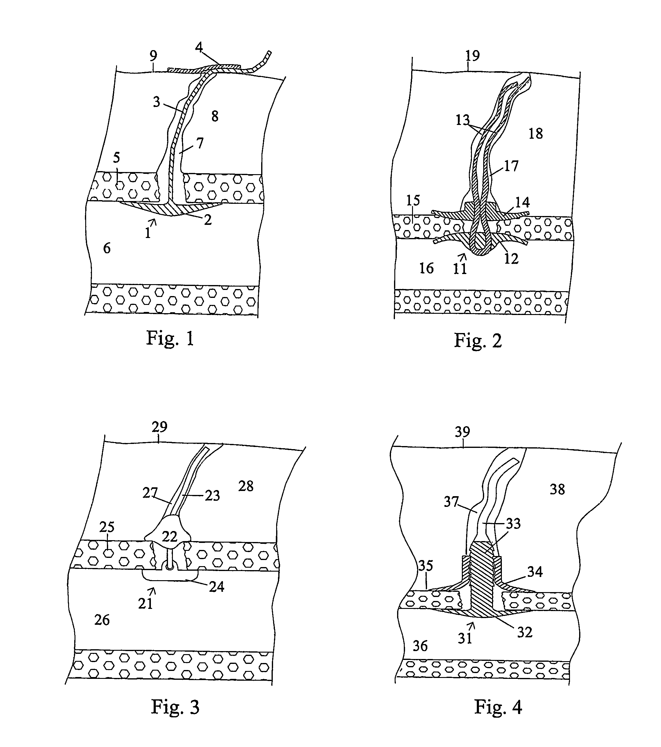 Wound closure and sealing device