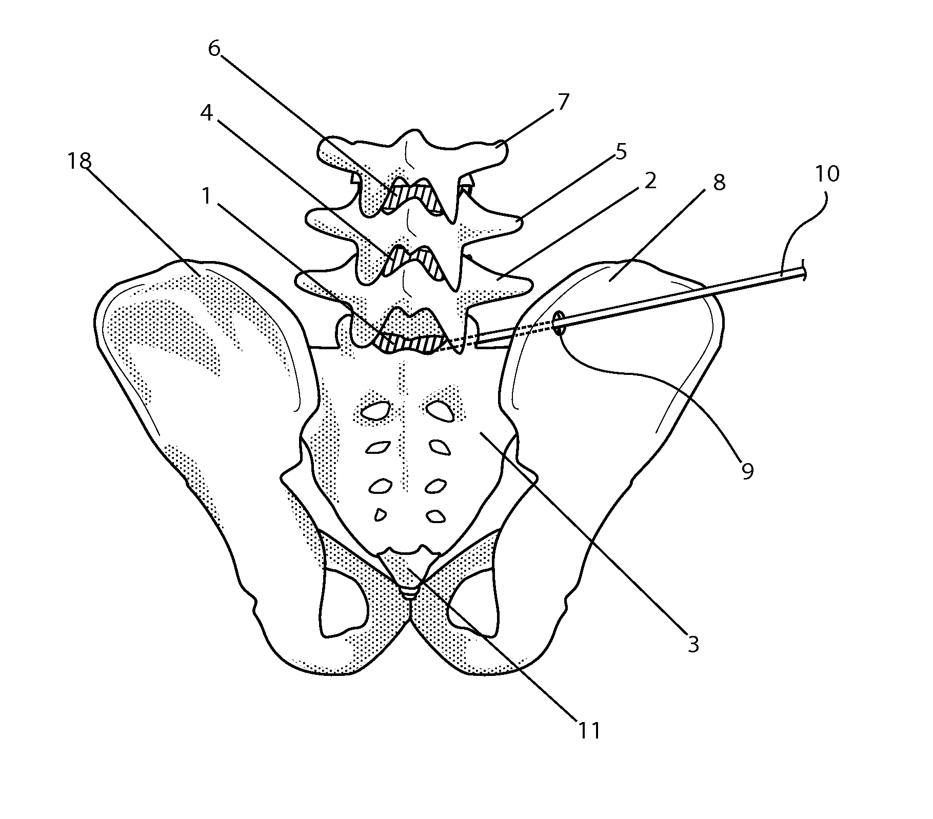 Trans-osseous oblique lumbosacral fusion system and method