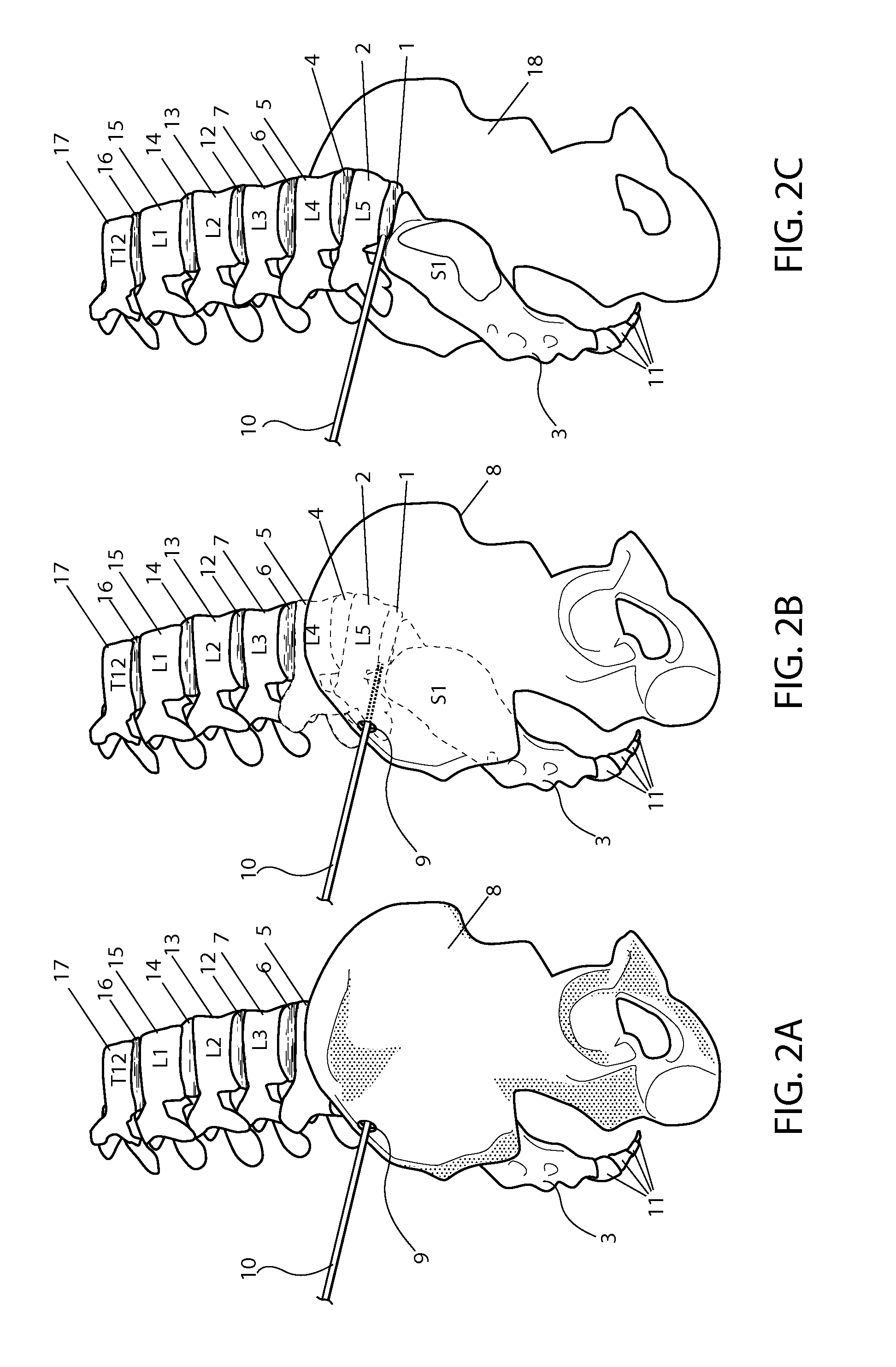 Trans-osseous oblique lumbosacral fusion system and method