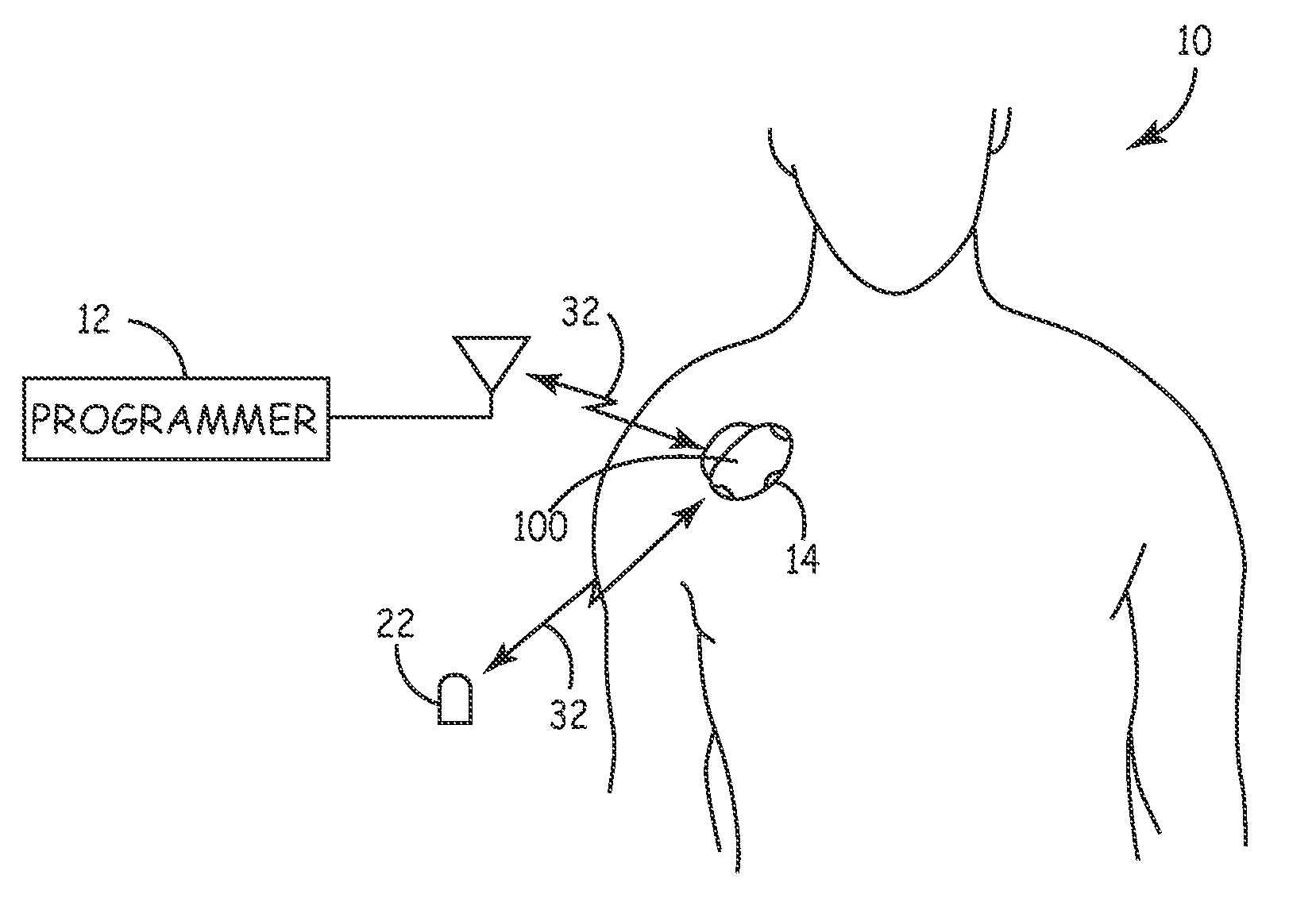 System and method for using cardiac events to trigger therapy for treating nervous system disorders