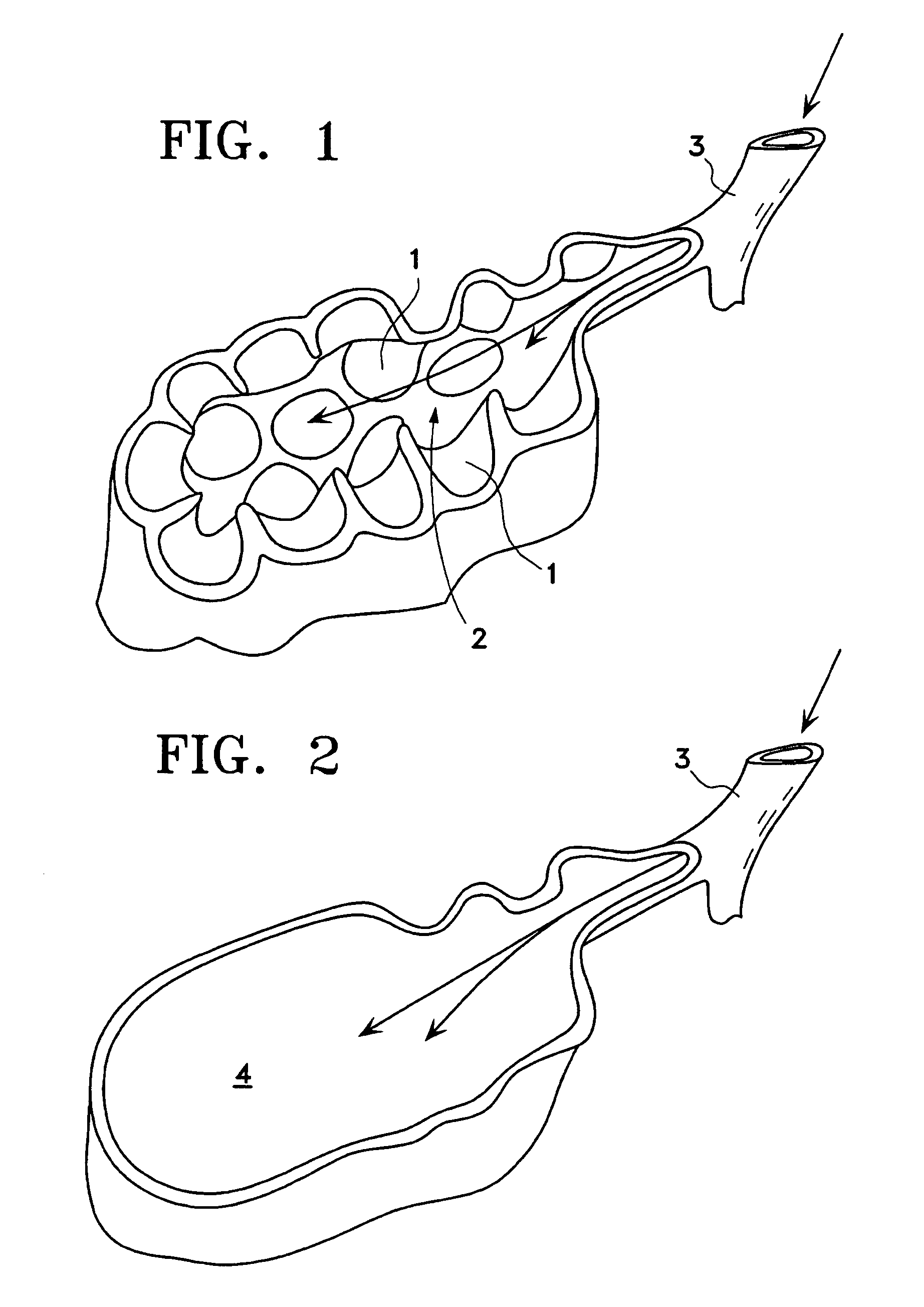 Method for lung volume reduction