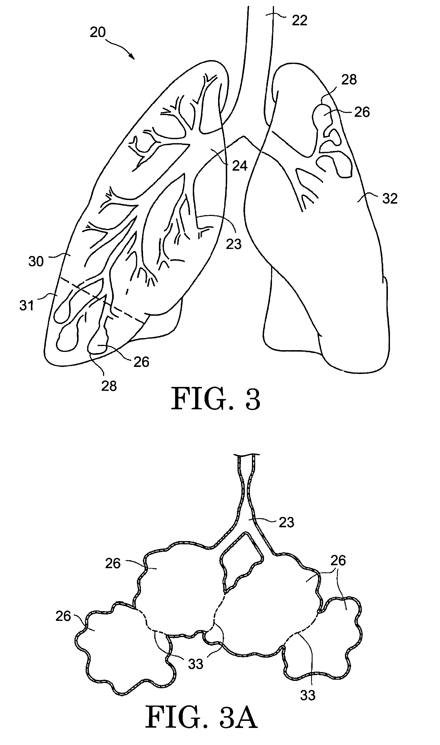 Method for lung volume reduction