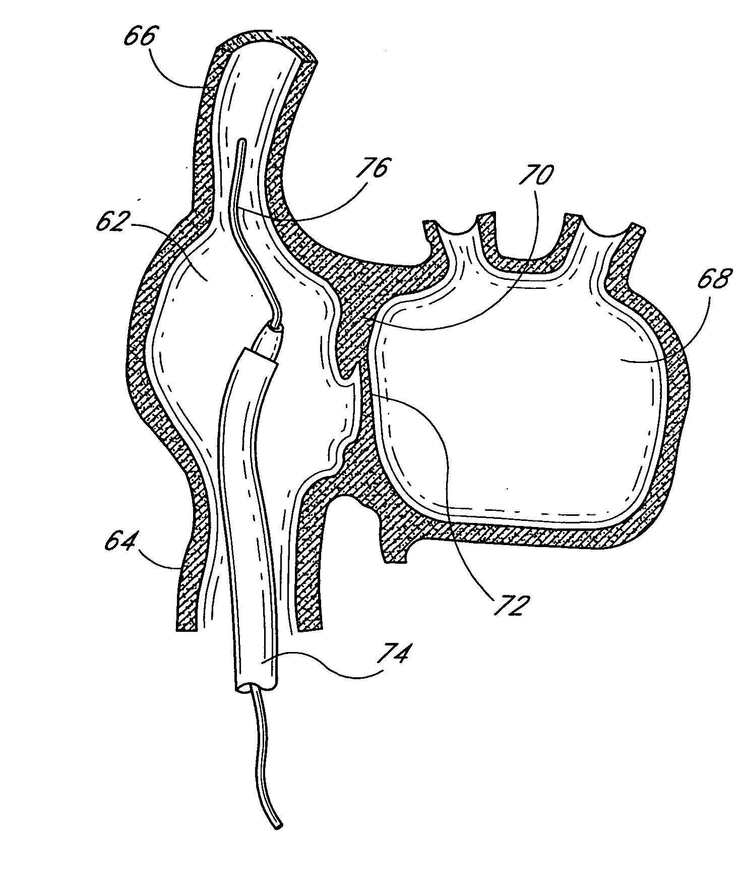 Method and apparatus for accessing the left atrial appendage