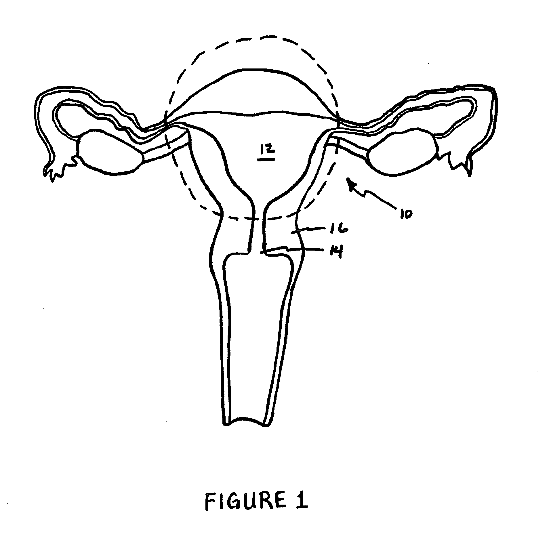 Intrauterine implant and methods of use