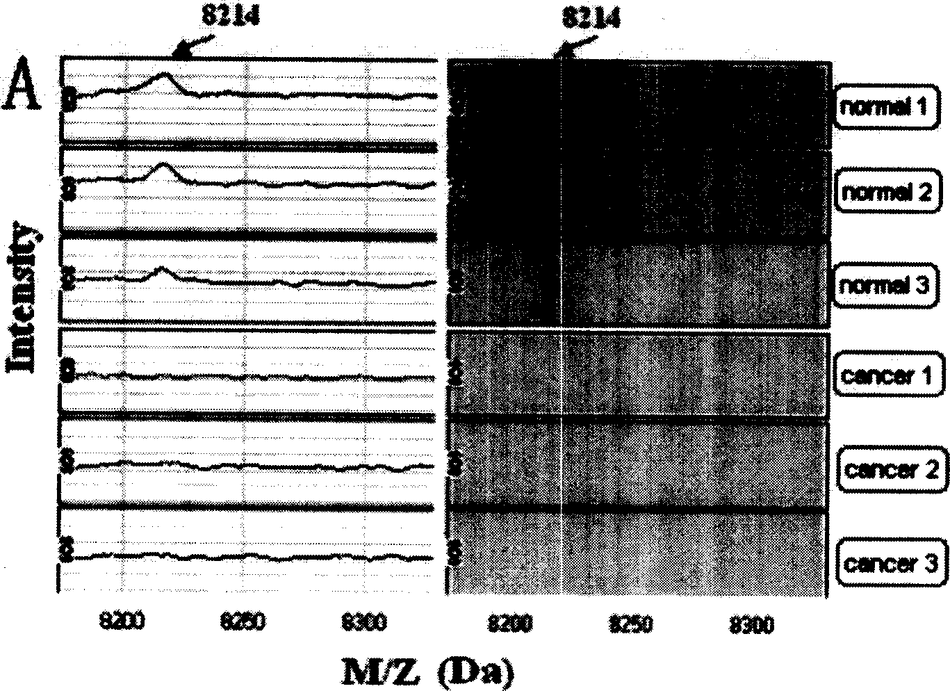 Method for detecting four kinds of tumor serum proteins