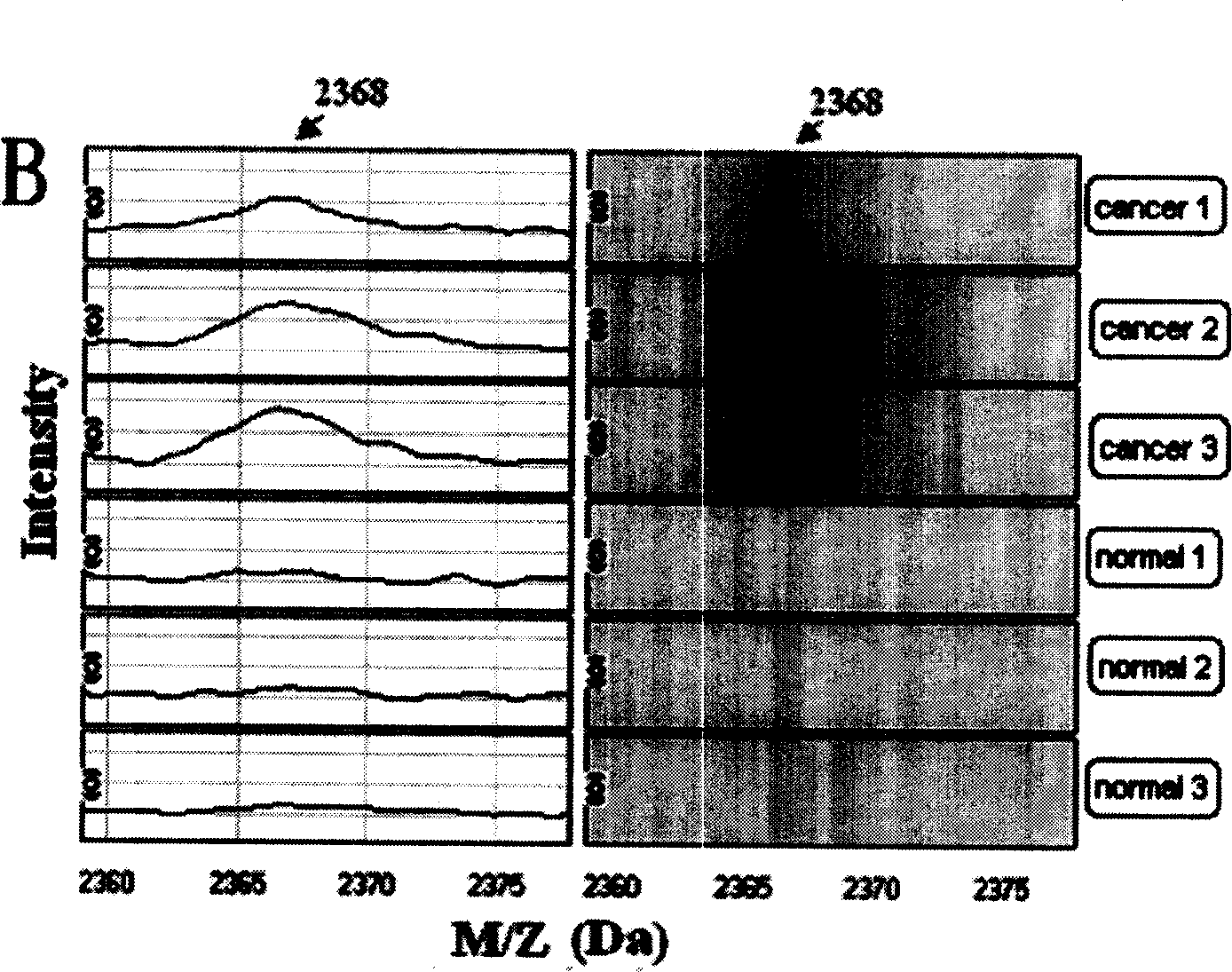 Method for detecting four kinds of tumor serum proteins