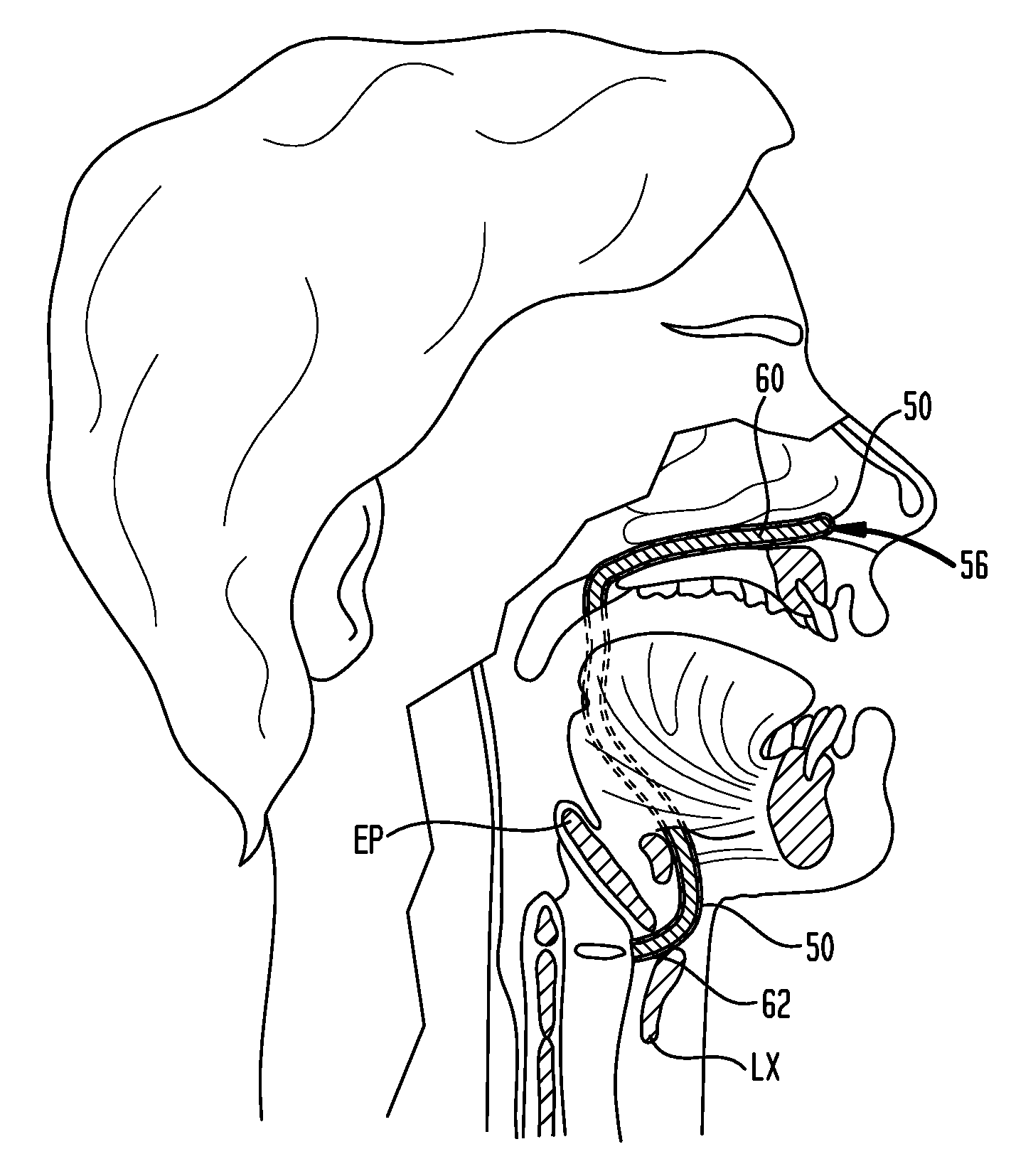 Methods and devices for forming an auxiliary airway for treating obstructive sleep apnea