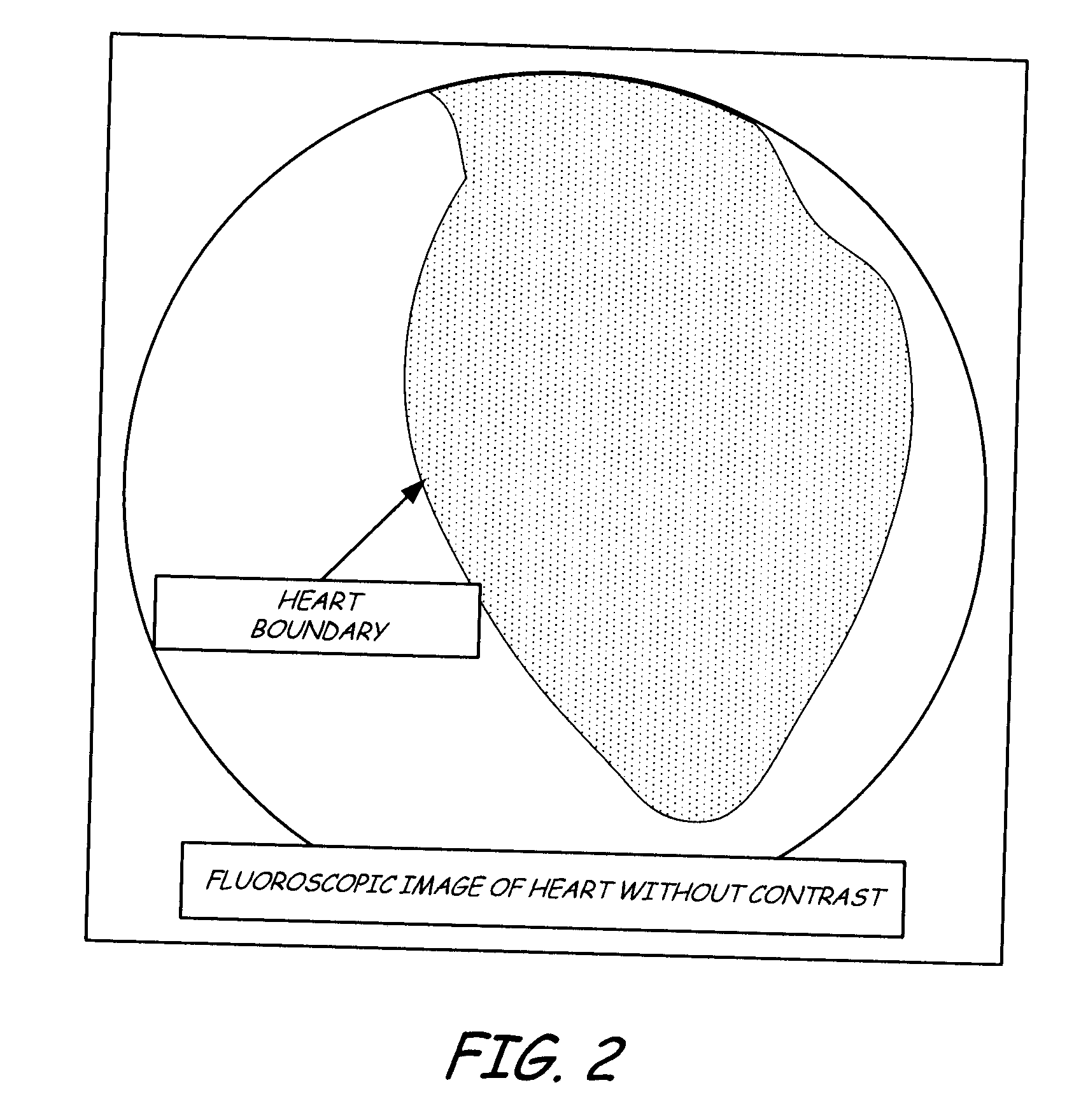 Pericardial space imaging for cardiac support device implantation