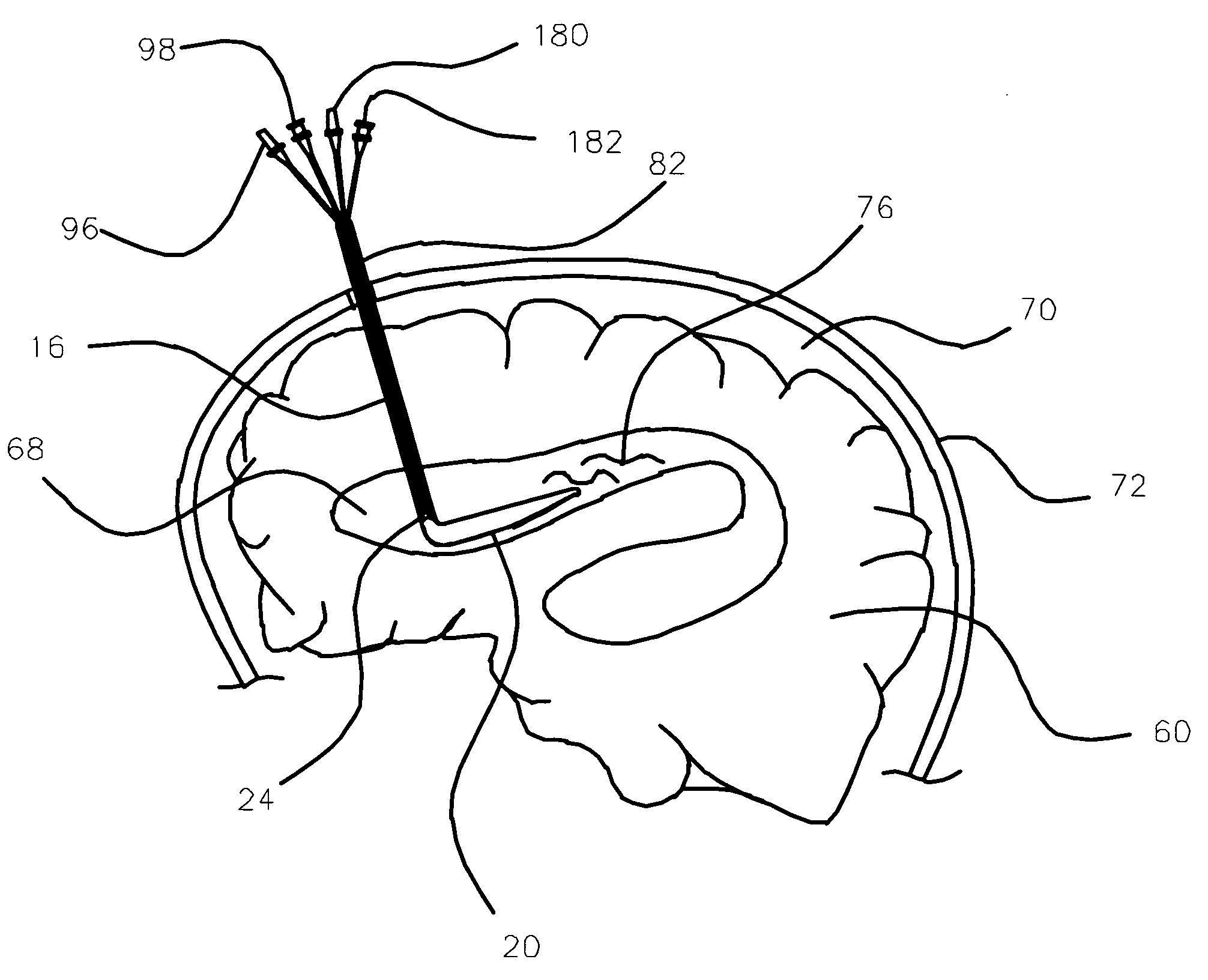 Medical device and method for temperature control and treatment of the brain and spinal cord