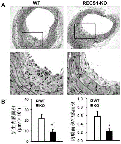 Function and application of centrifugal force and shear stress response gene 1 (recs1) in the treatment of restenosis after vascular injury