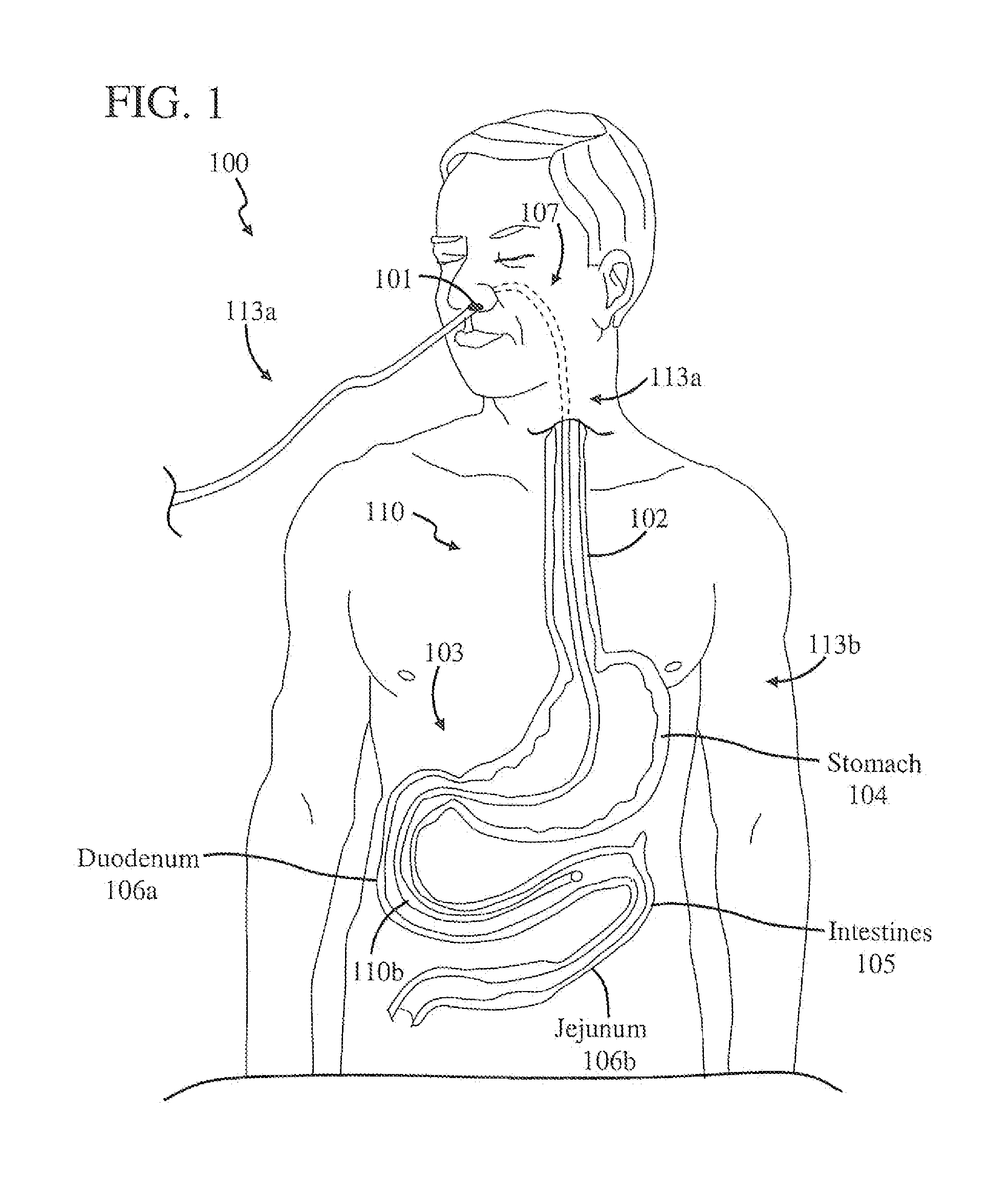 Catheter and method of making the same
