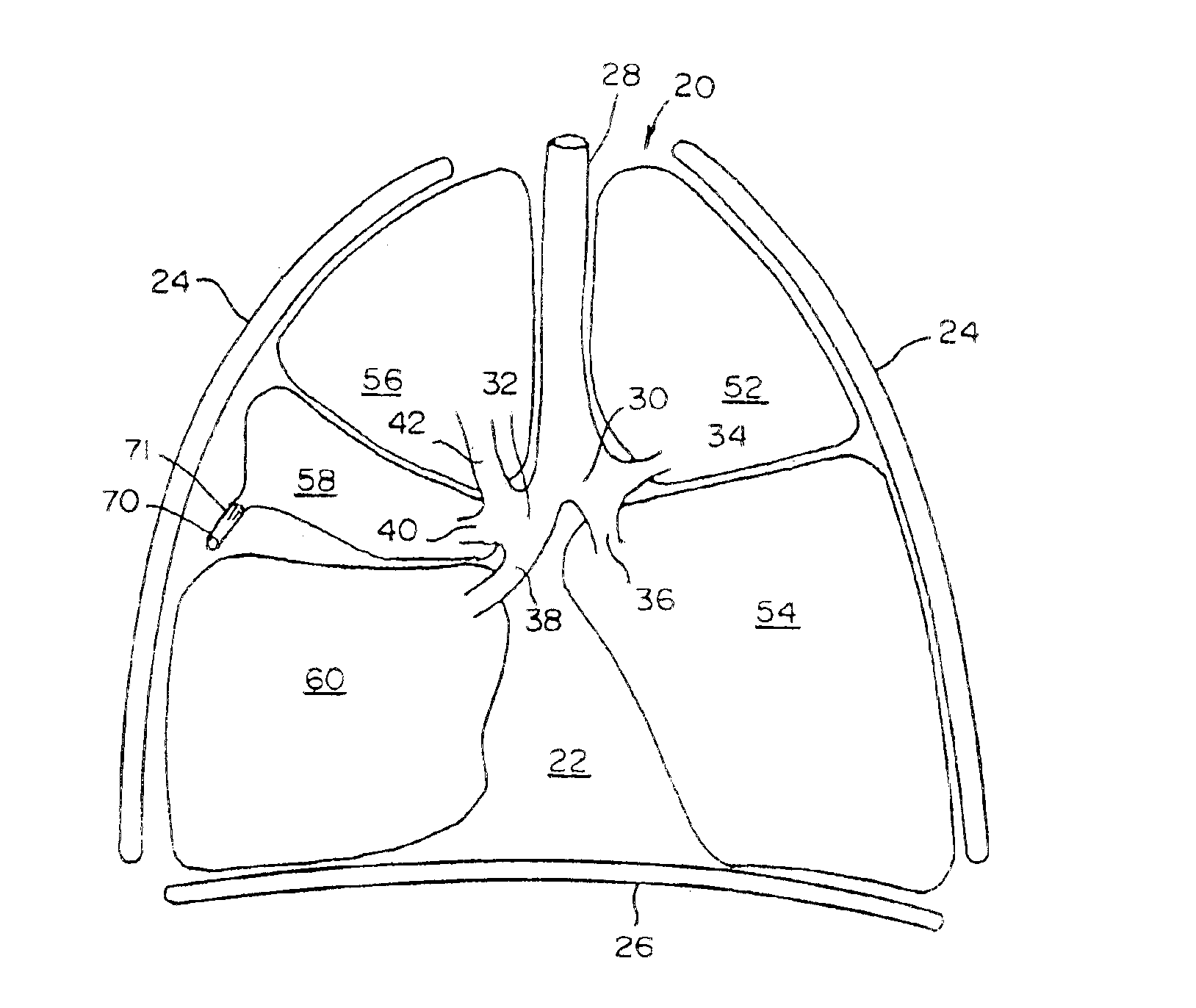 Constriction device viewable under X ray fluoroscopy
