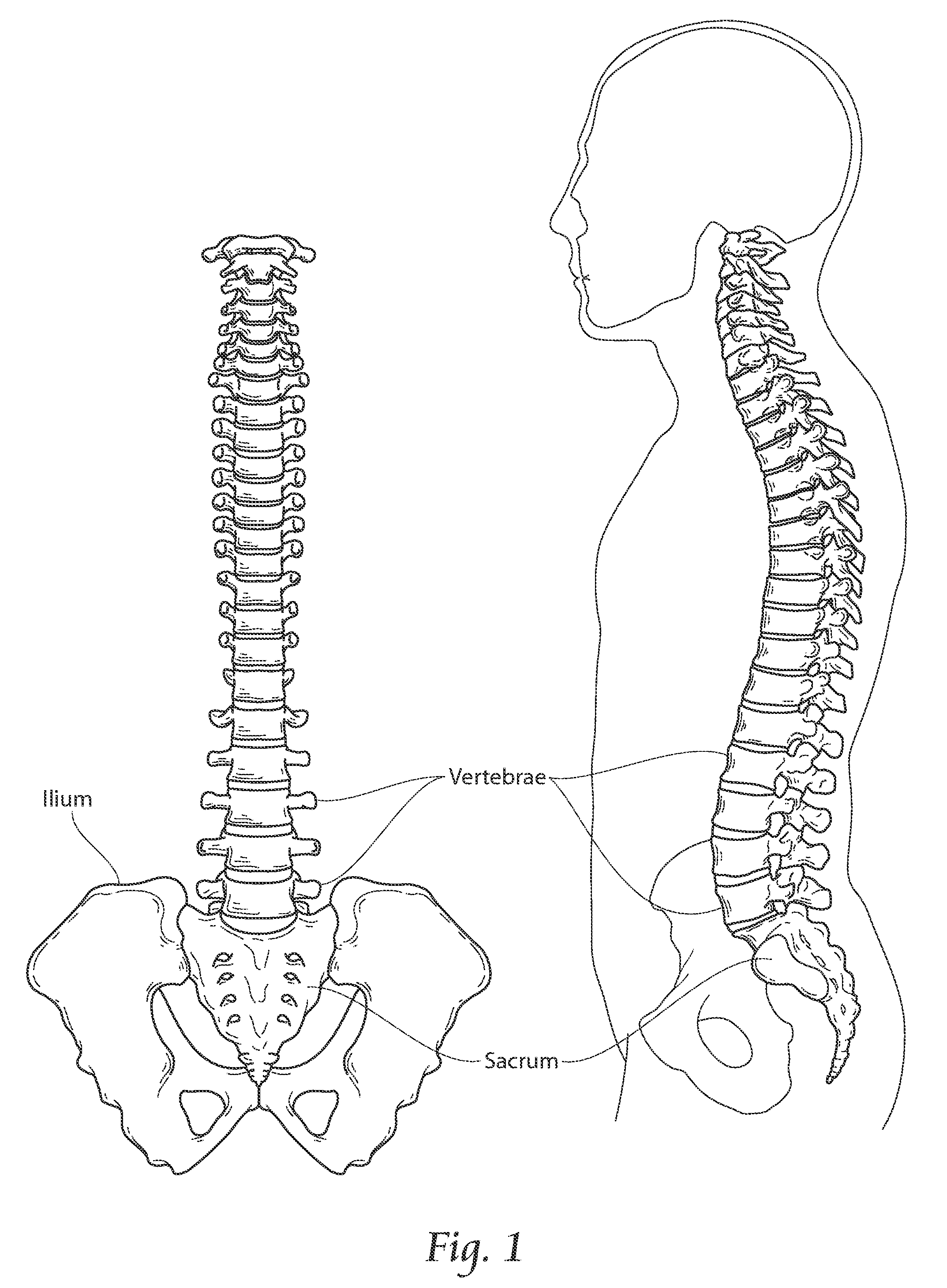 Apparatus, systems, and methods for stablizing a spondylolisthesis