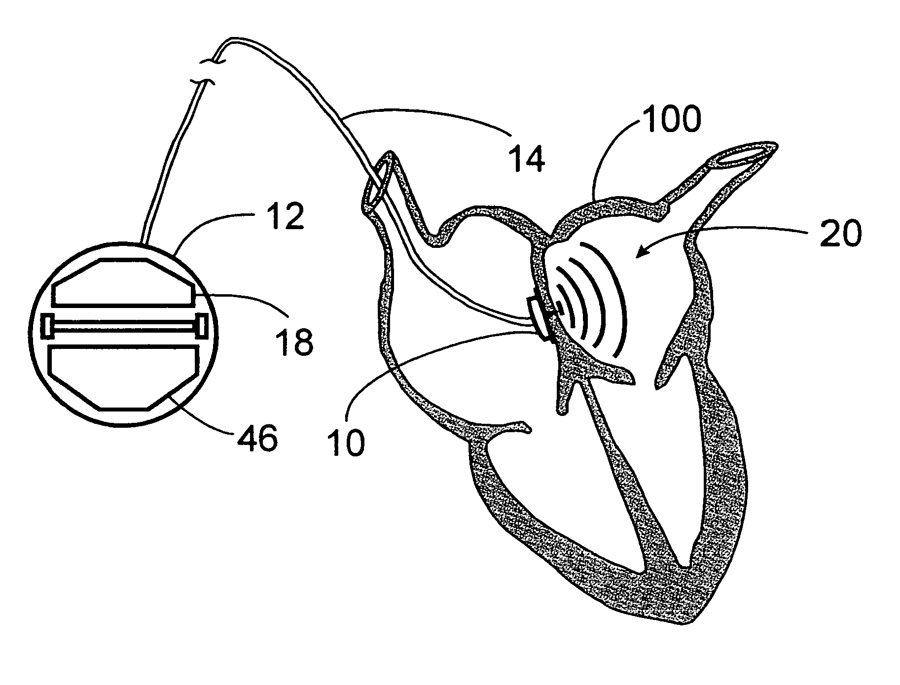 Method for preventing thrombus formation