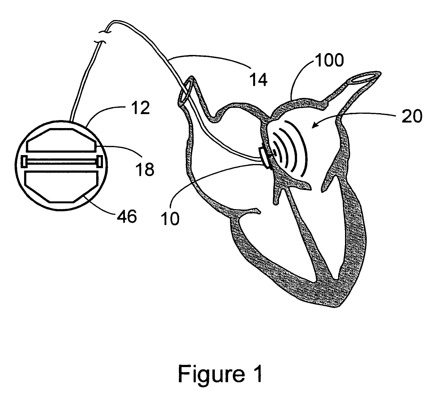 Method for preventing thrombus formation