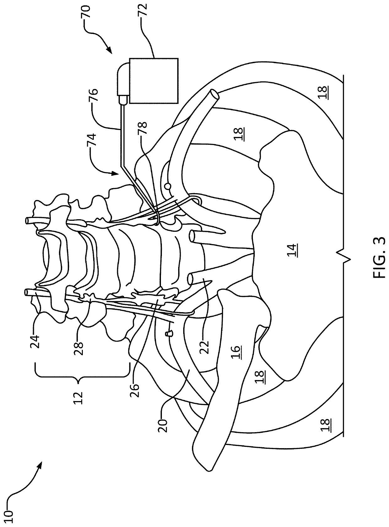 Systems and methods for stellate ganglion stimulation and ablation