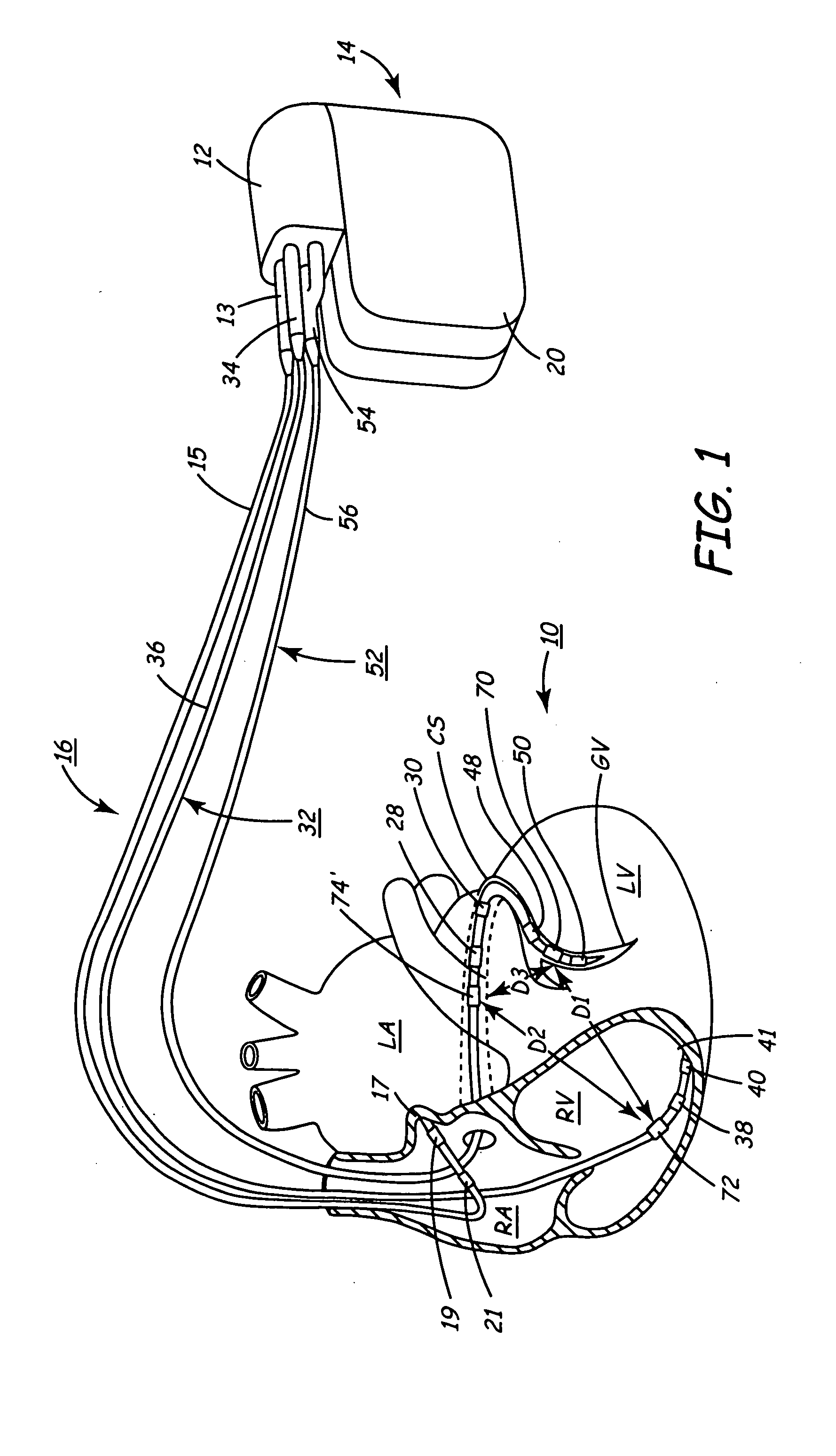 Implantable medical device for monitoring cardiac blood pressure and chamber dimension