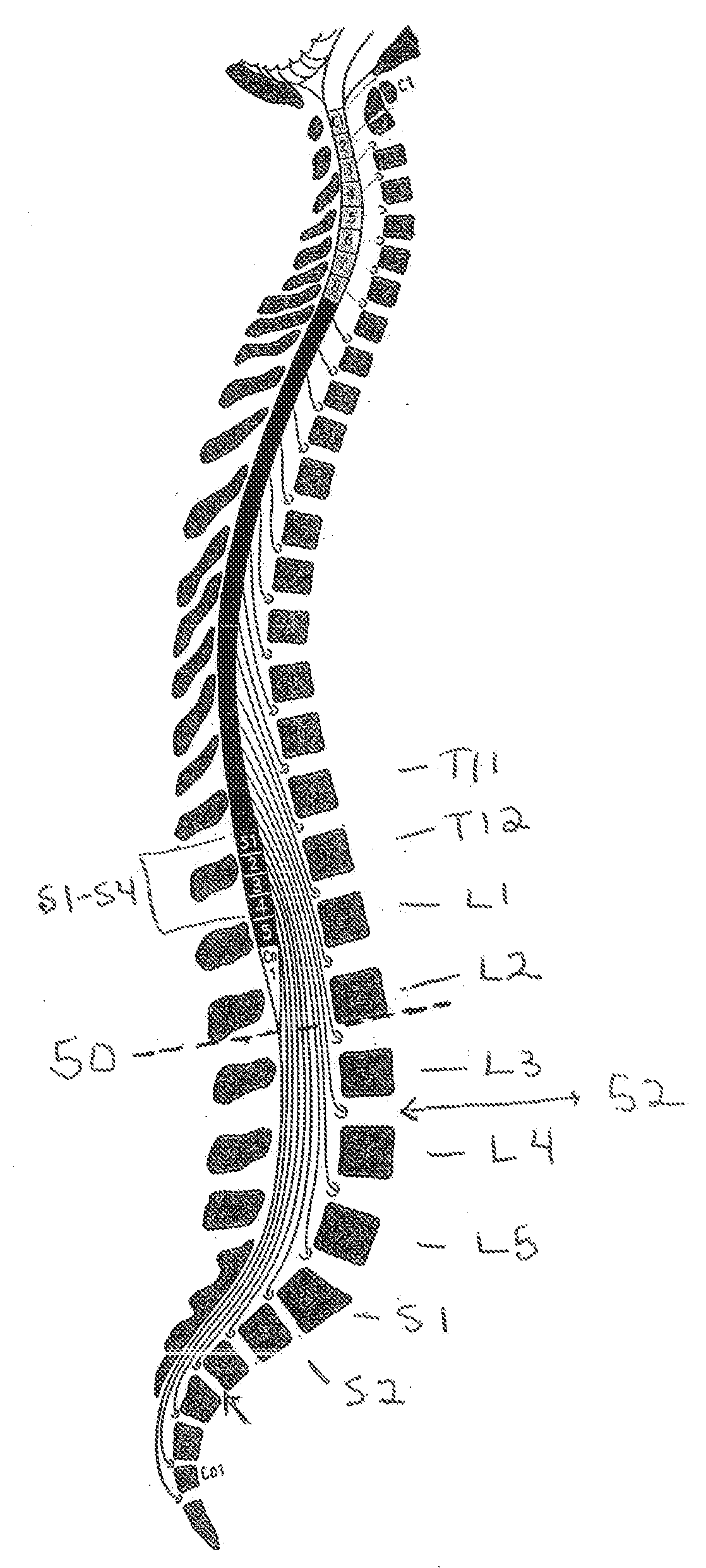 Drug Delivery Methods and Devices for Treating Stress Urinary Incontinence