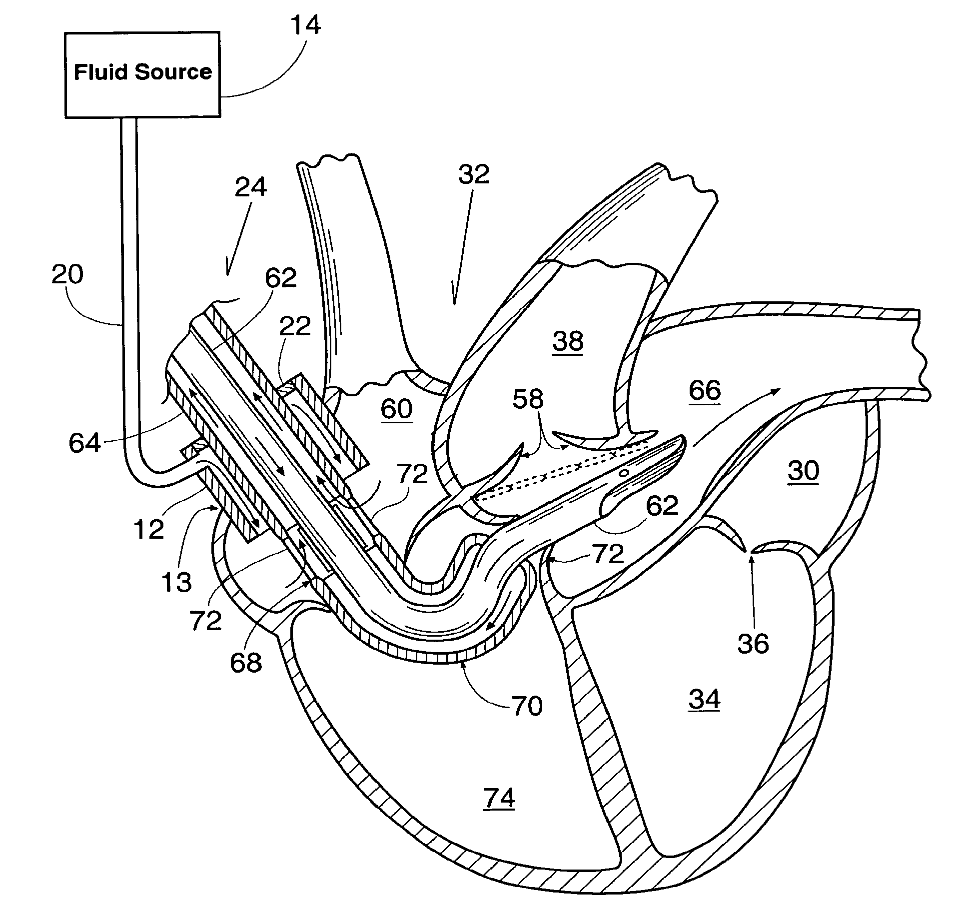 Method and Apparatus for Preventing Air Embolisms