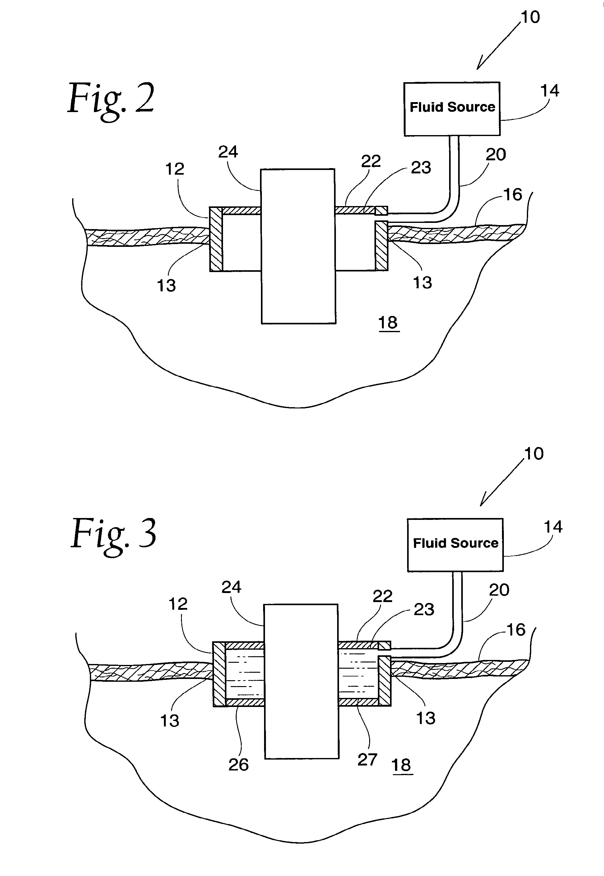 Method and Apparatus for Preventing Air Embolisms
