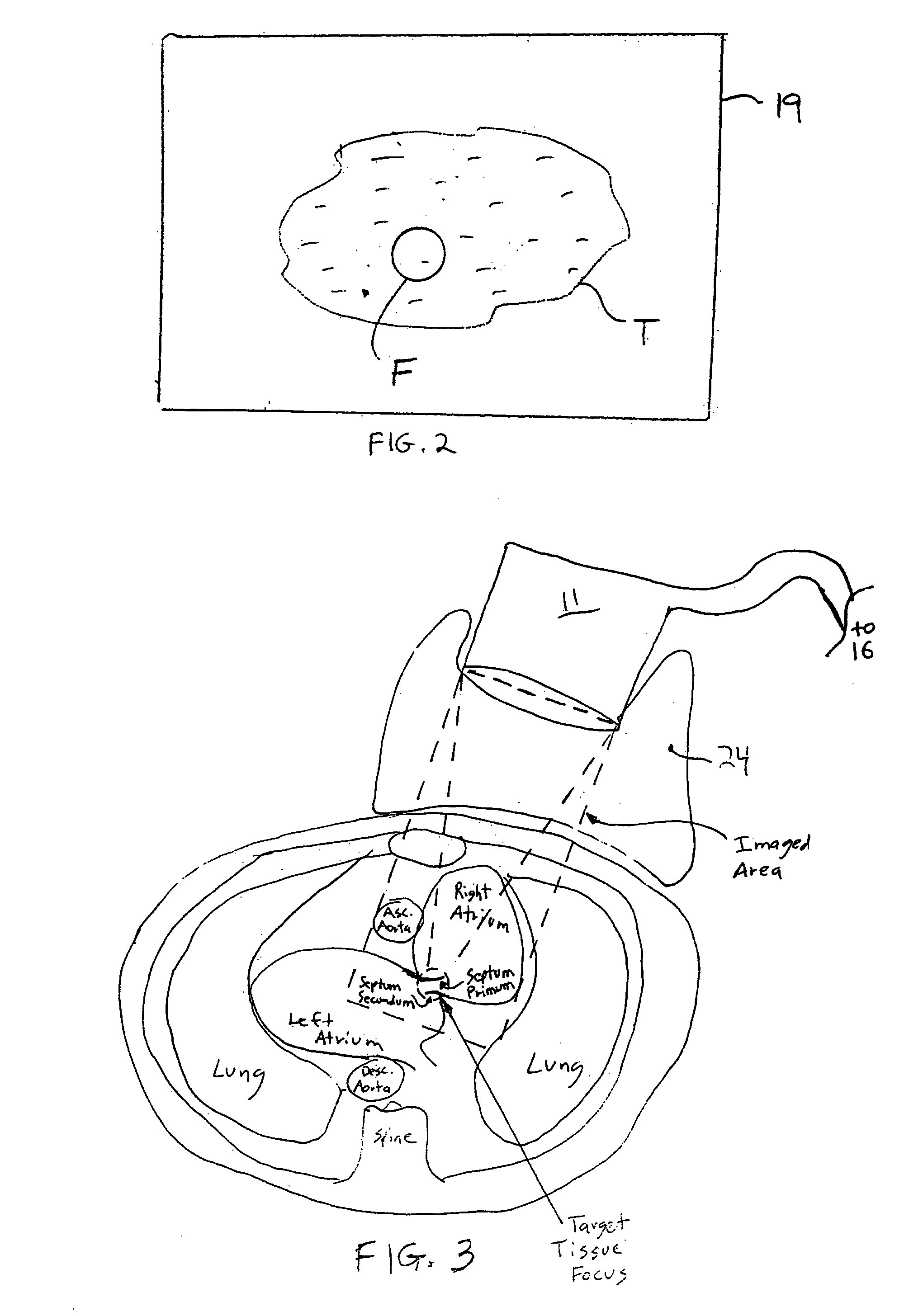 Methods and apparatus for non-invasively treating atrial fibrillation using high intensity focused ultrasound