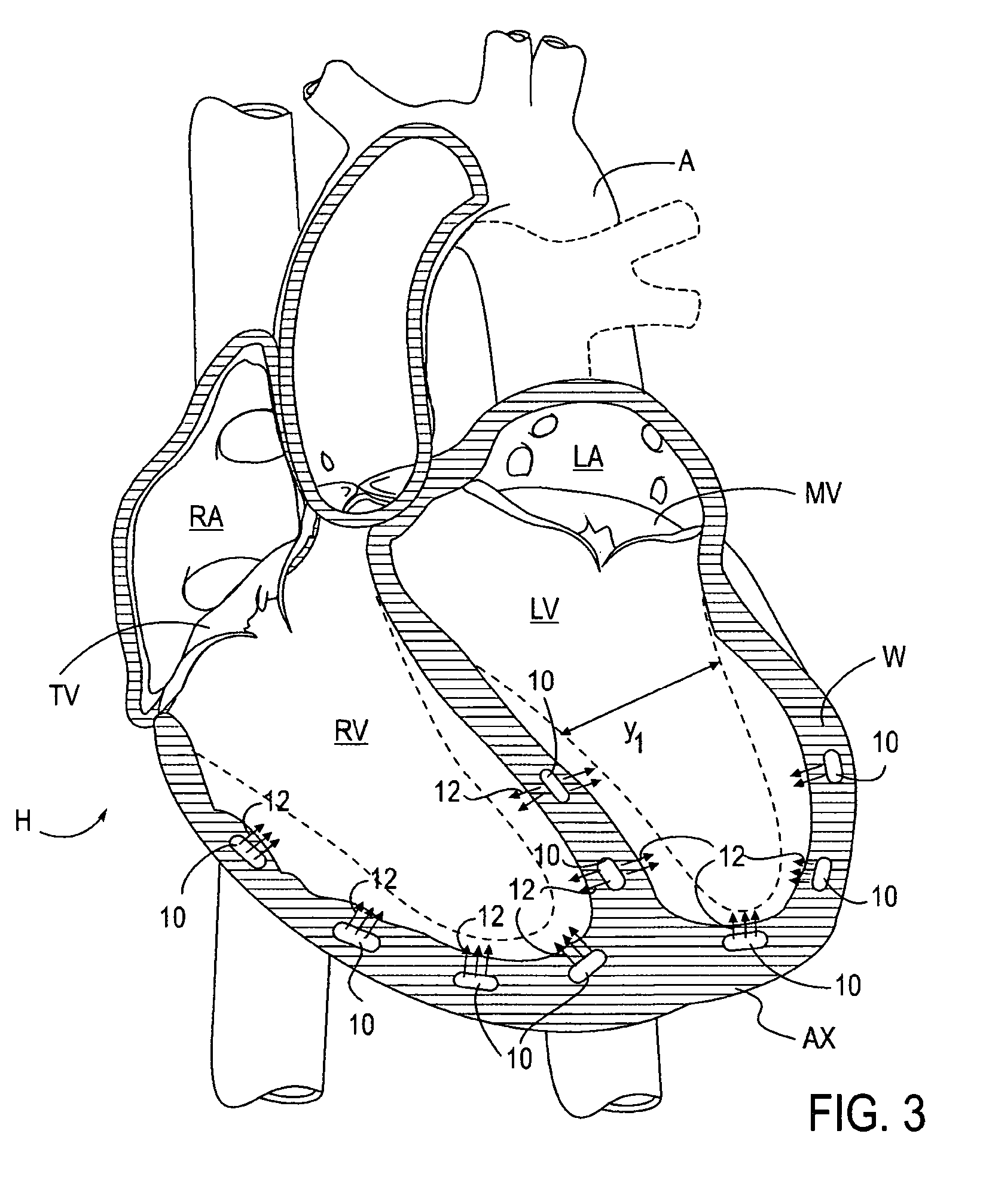 Magnetic devices and methods for reshaping heart anatomy
