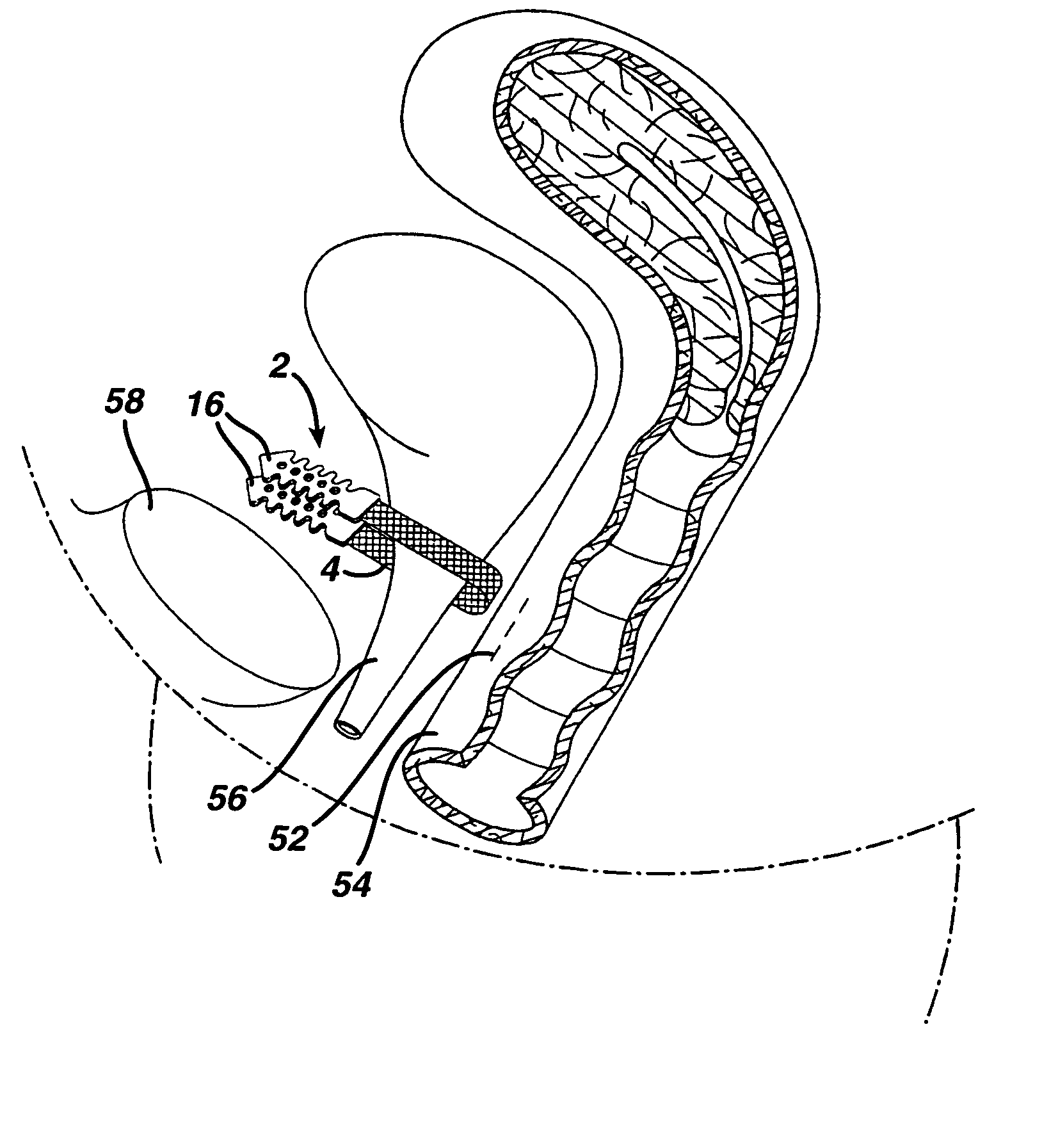 Minimally invasive medical implant and insertion device and method for using the same